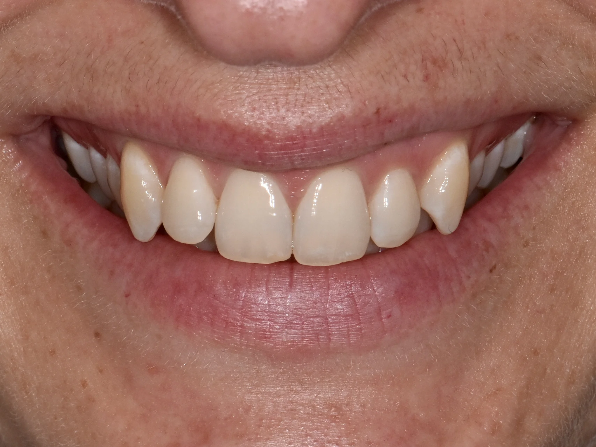 Invisalign (10 months), front view of smile
