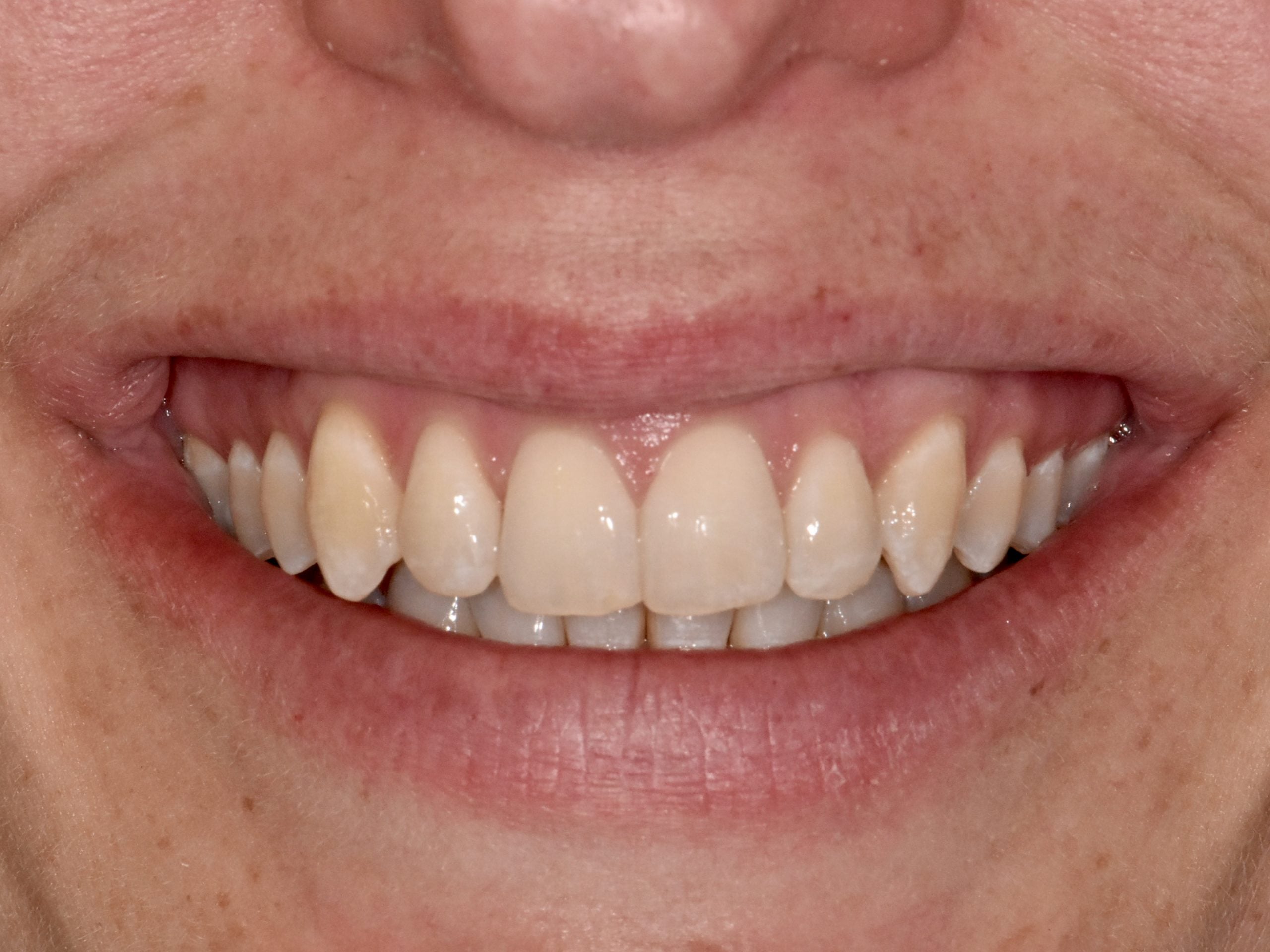 Invisalign (10 months), front view of smile