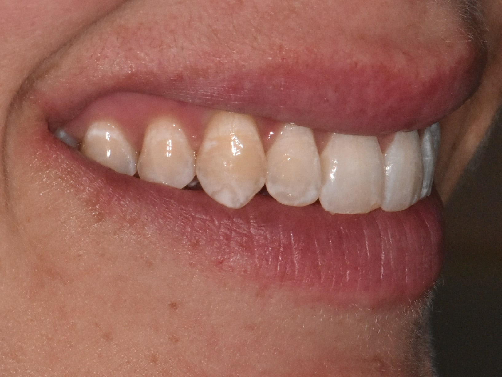 Invisalign (10 months), right side view of smile