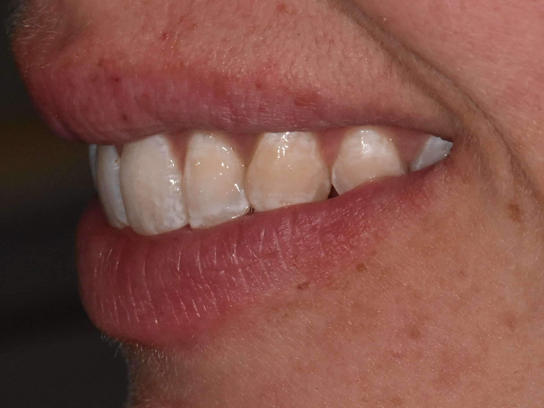 Invisalign (10 months), left side view of smile