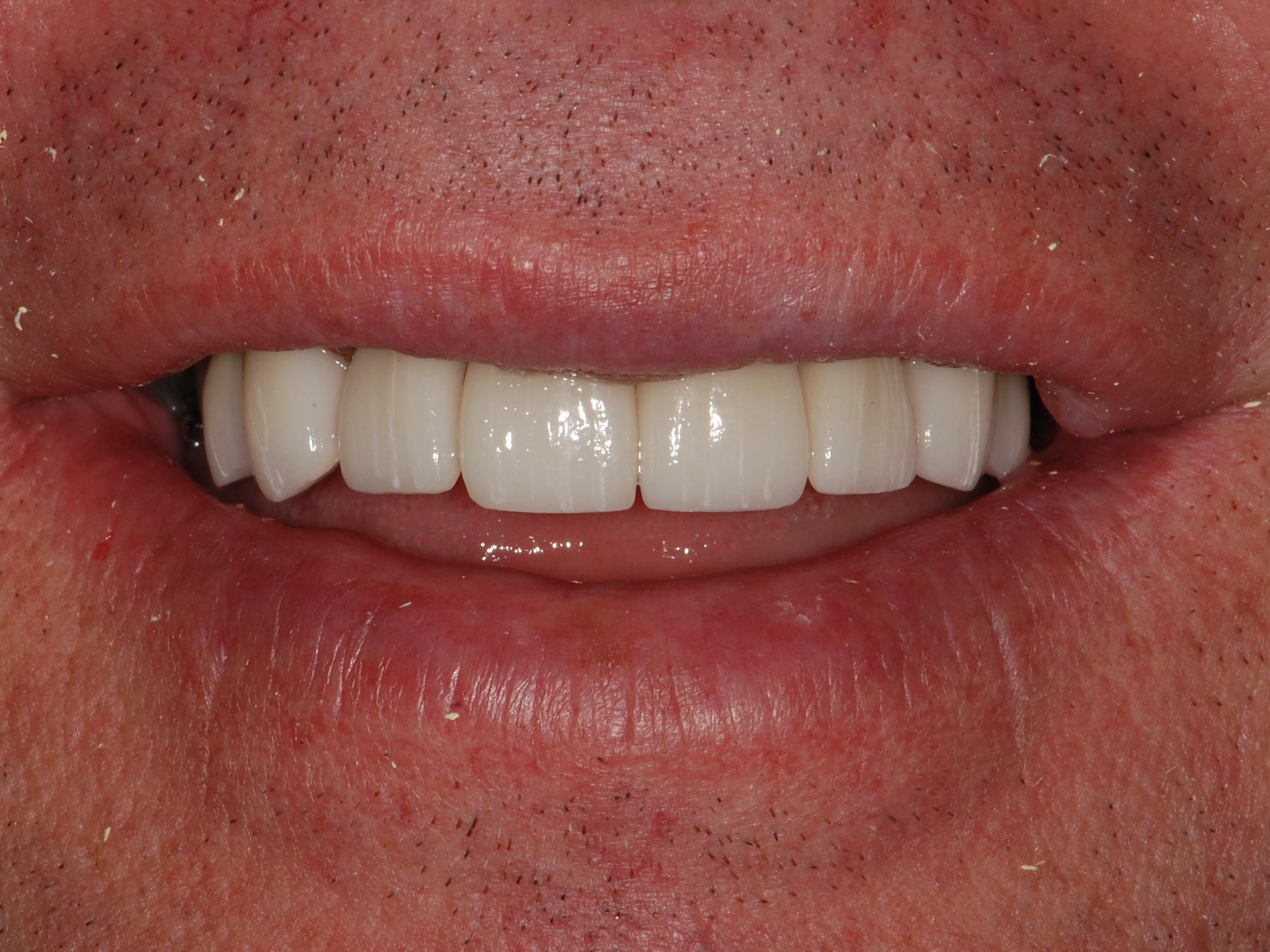 8 porcelain veneers, after treatment, front view of smile
