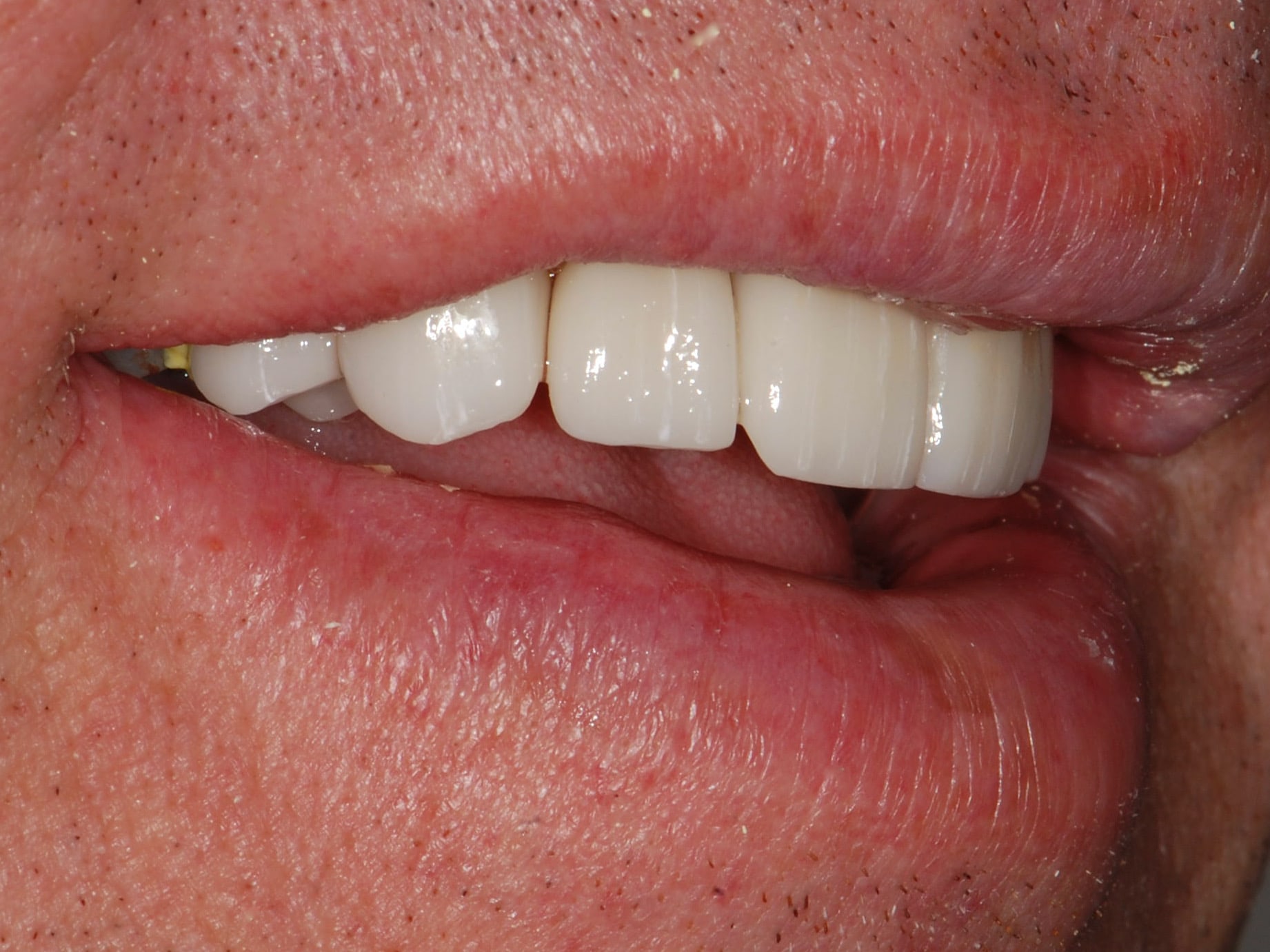 8 porcelain veneers, after treatment, left side view of smile