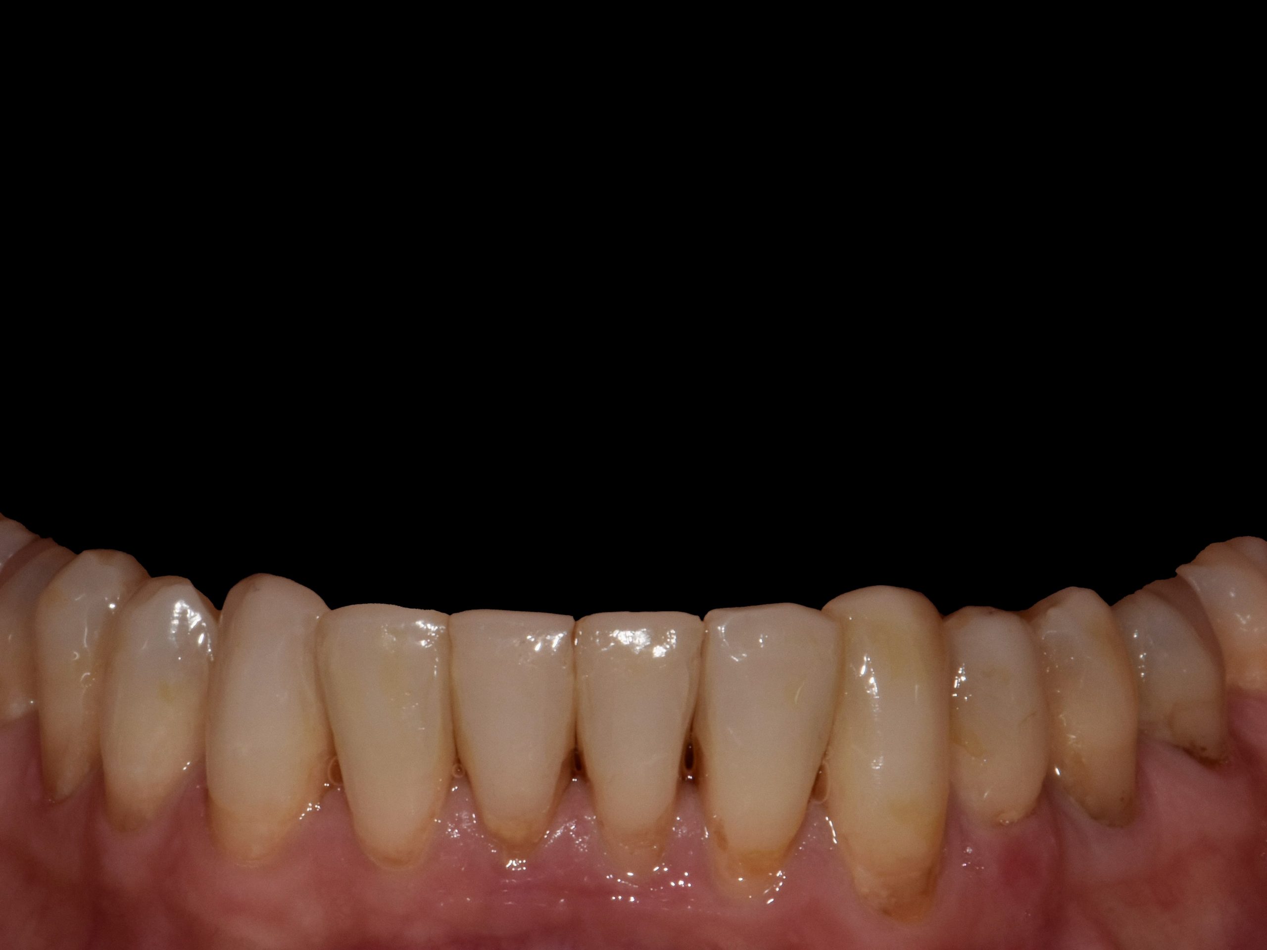 8 porcelain veneers, after treatment, close-up of the lower teeth