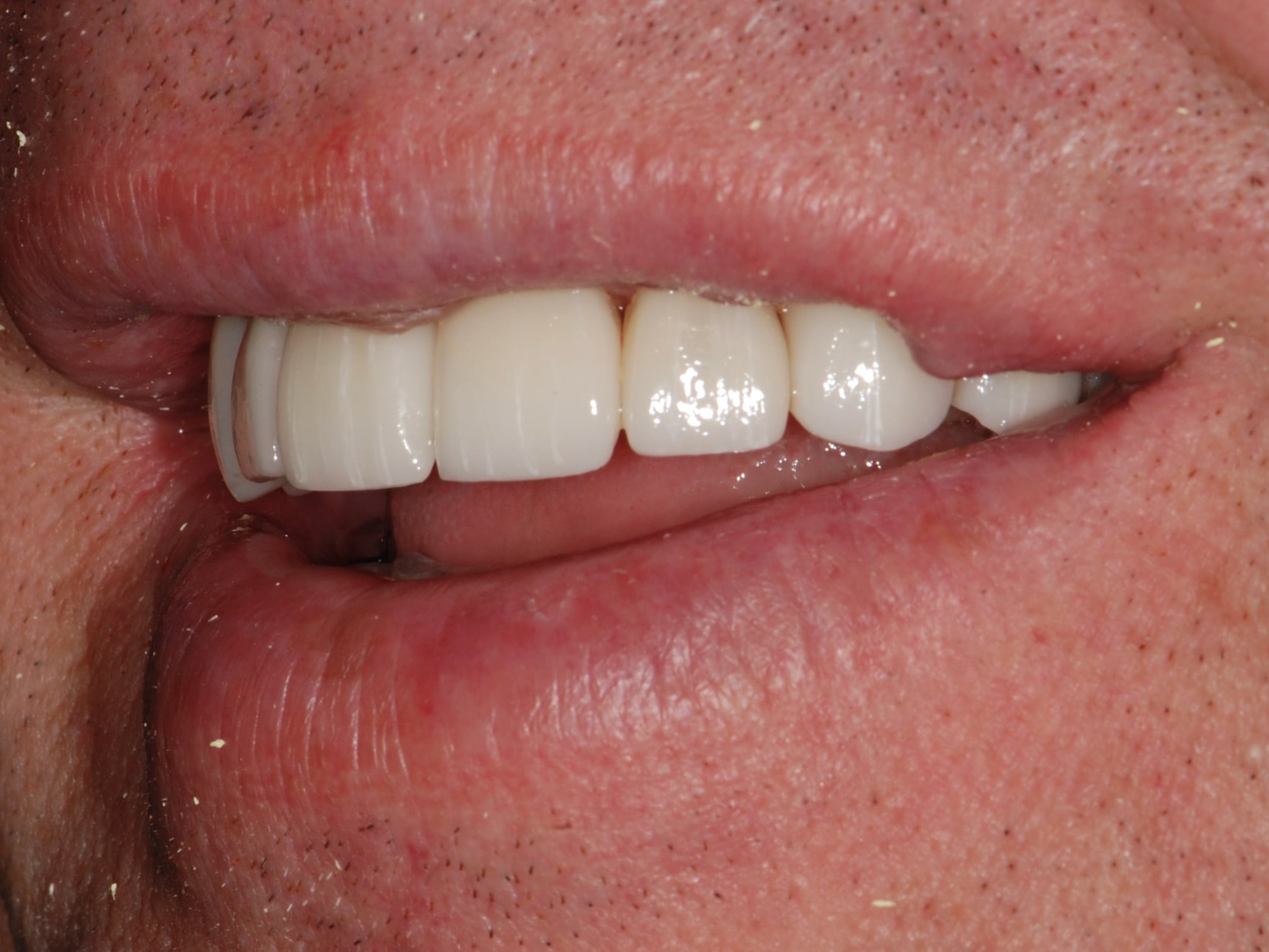 8 porcelain veneers, after treatment, right side view of smile