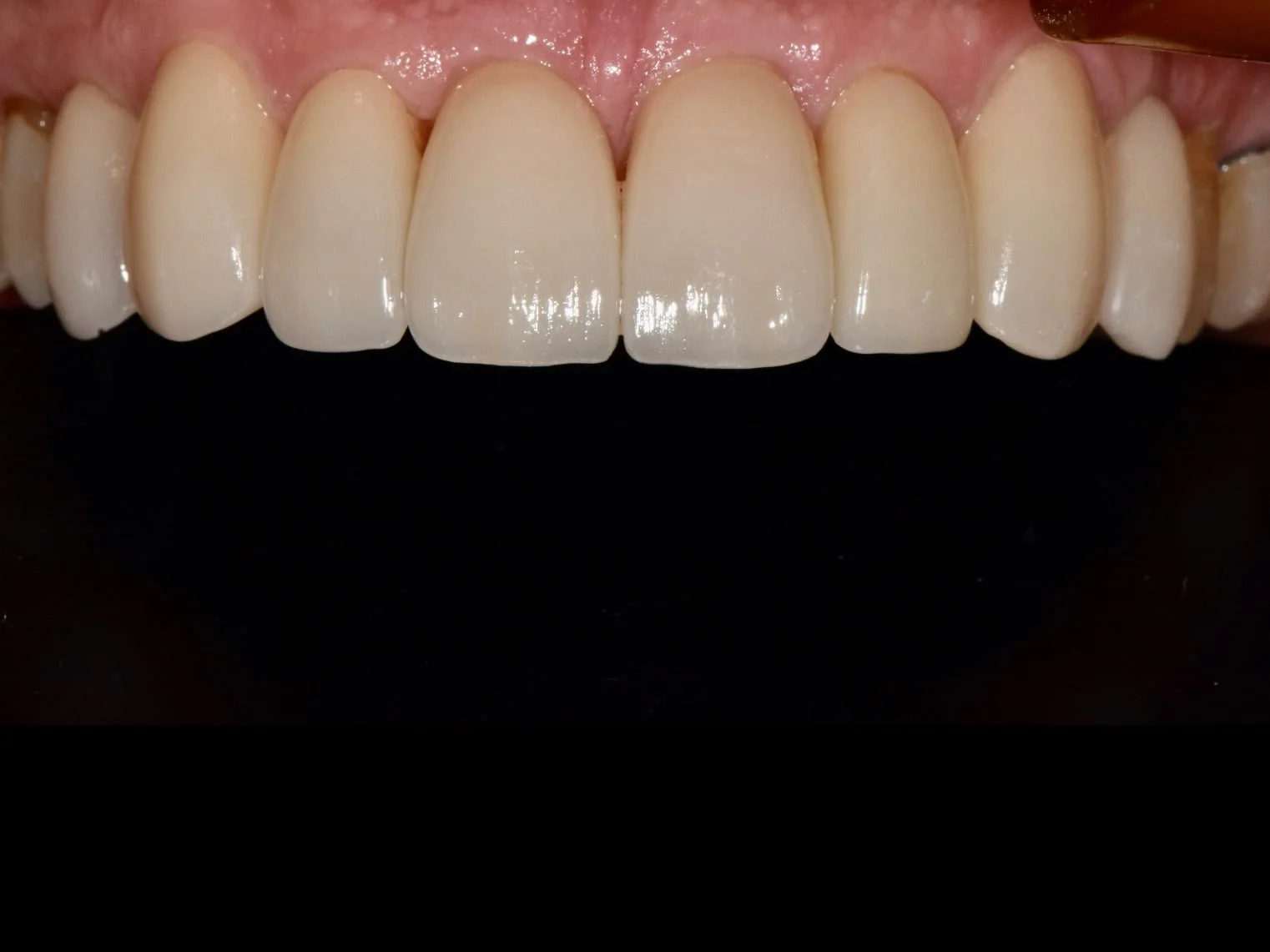 8 porcelain veneers, after treatment, close-up of the upper teeth