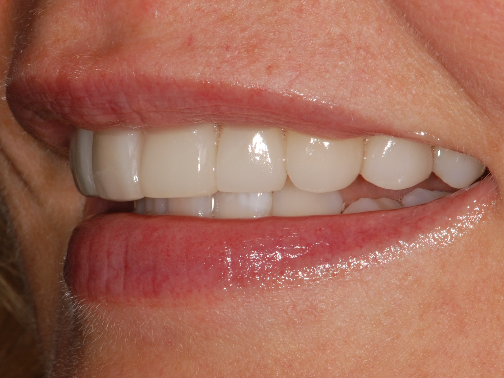 8 porcelain veneers, after treatment, right side view of smile