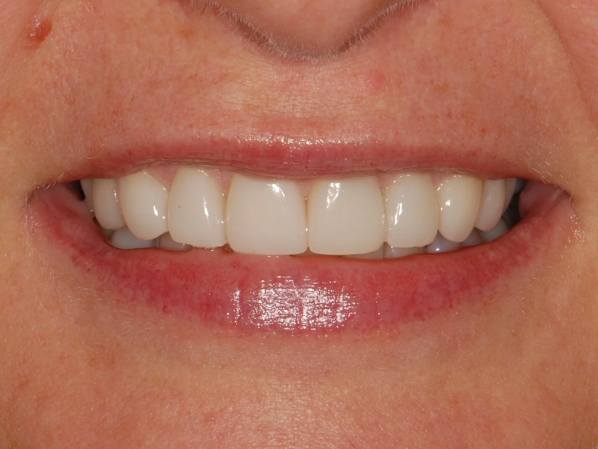 8 porcelain veneers, after treatment, front view of smile