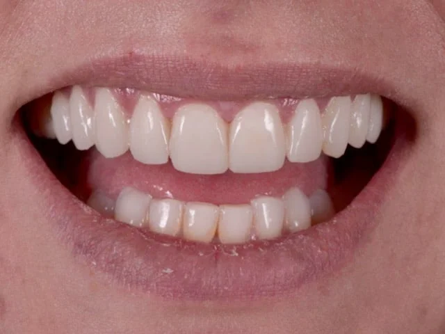 10 porcelain veneers, after treatment, front view of smile