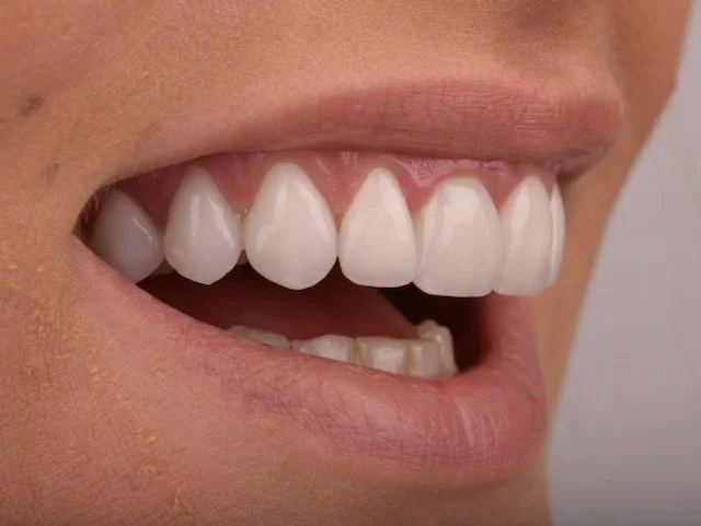 10 porcelain veneers, after treatment, left side view of smile