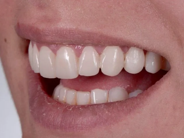 10 porcelain veneers, after treatment, right side view of smile