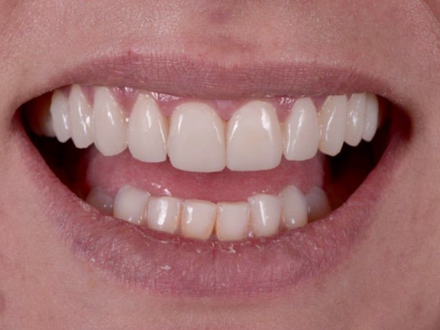 10 porcelain veneers, after treatment, front view of smile