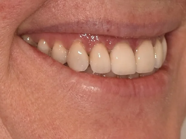 Gum lift, dental crowns and porcelain veneers, after treatment, left side view of smile