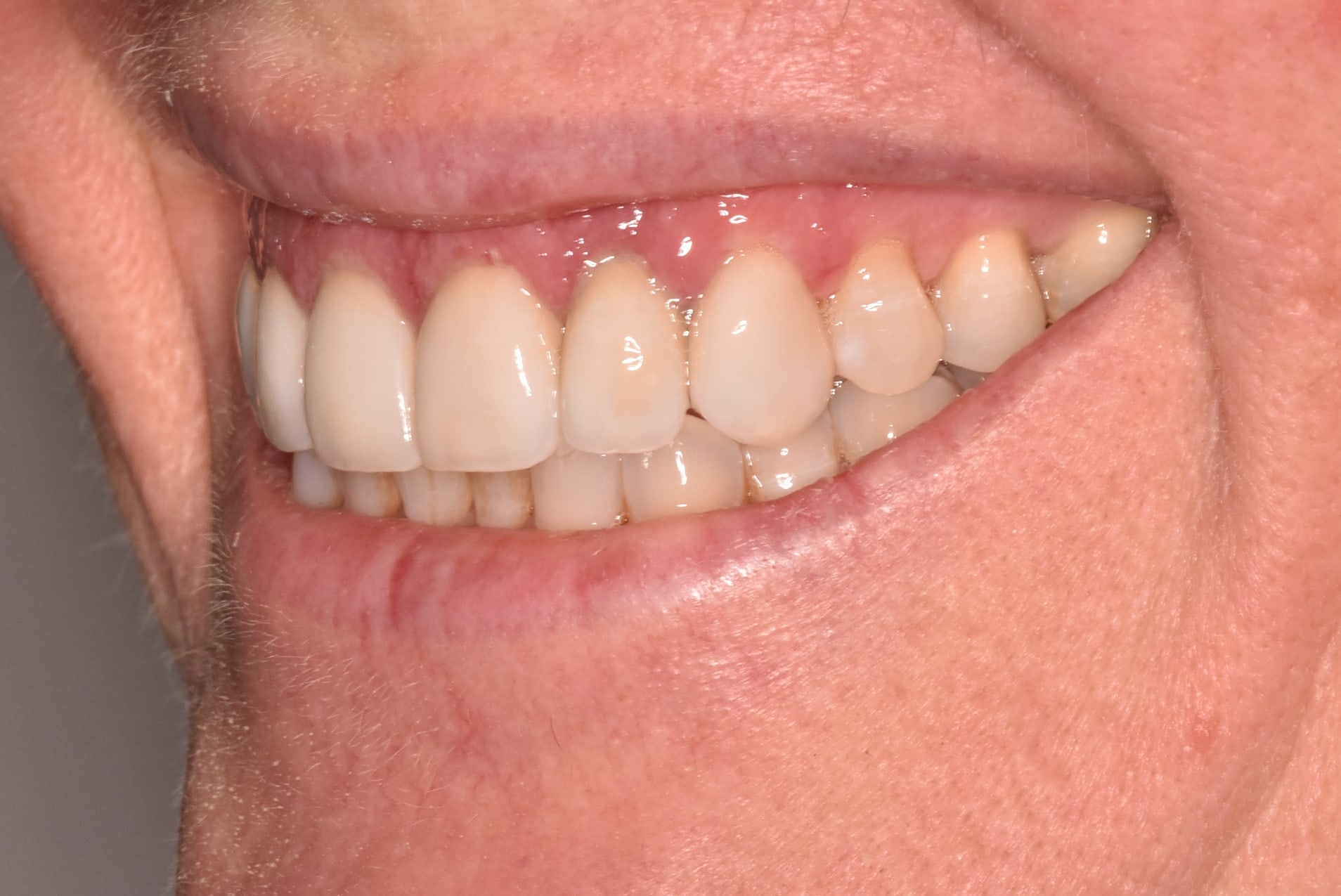 Gum lift, dental crowns and porcelain veneers, after treatment, right side view of smile