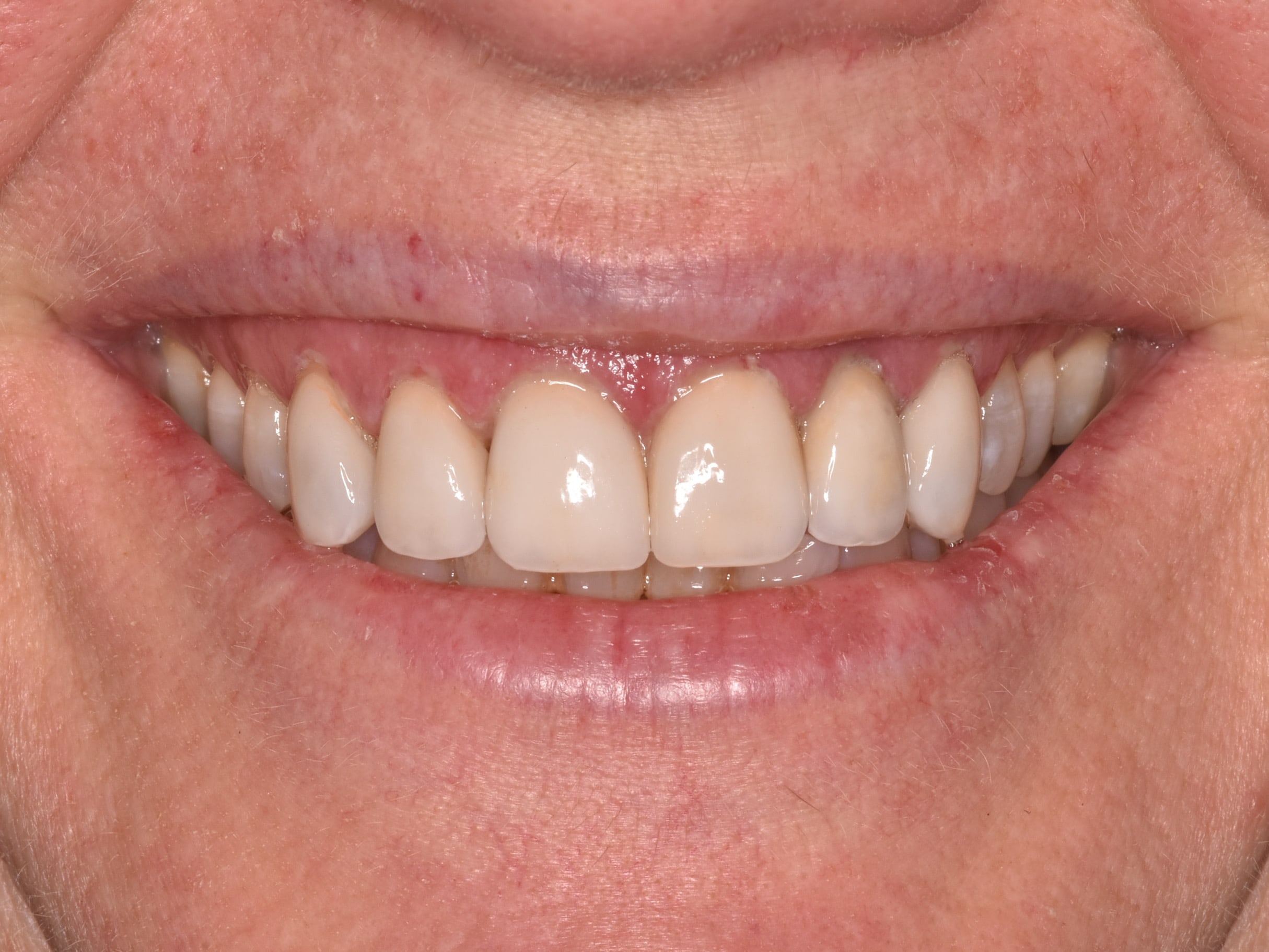 Gum lift, dental crowns and porcelain veneers, after treatment, front view of smile