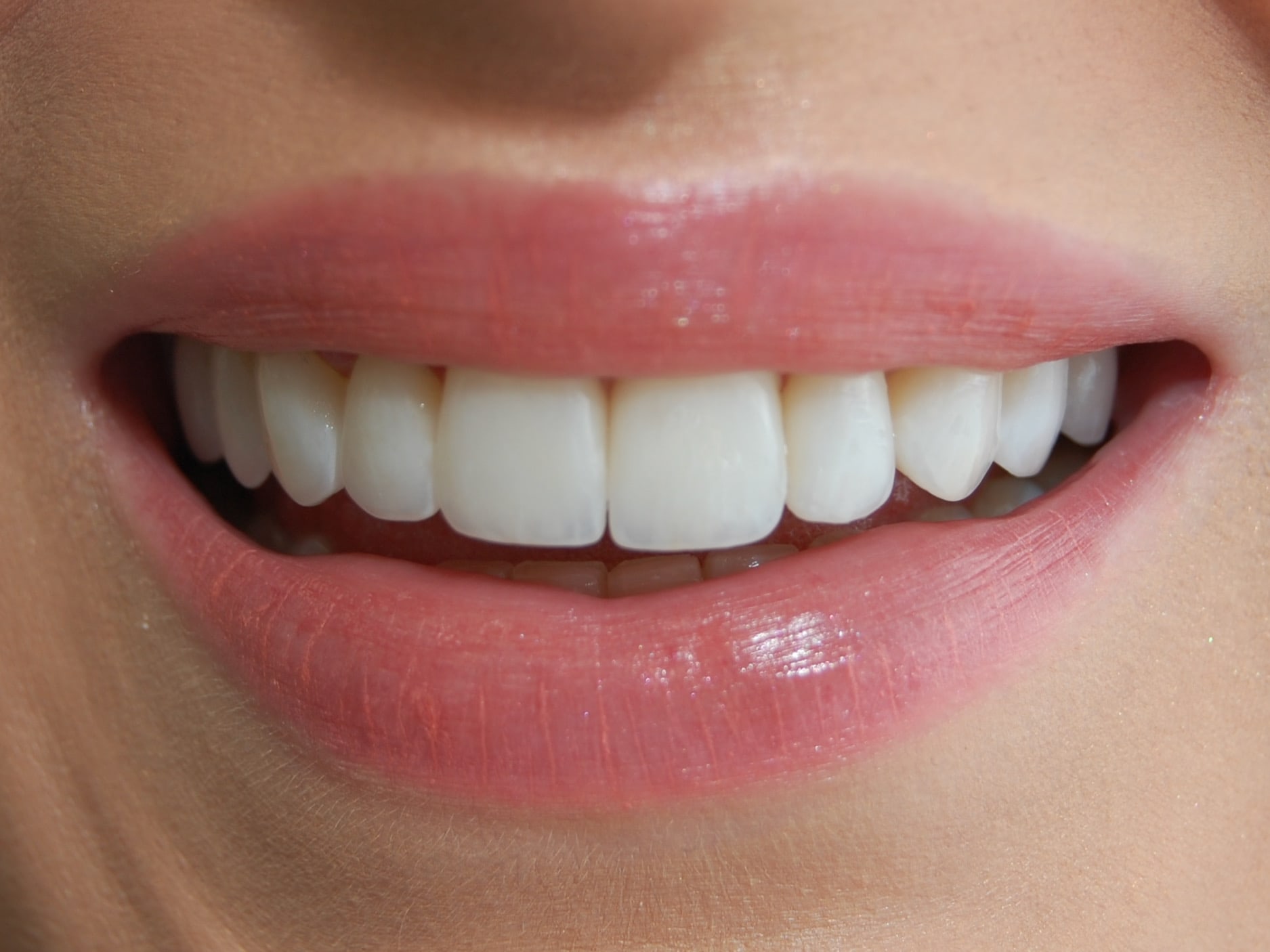 10 porcelain veneers, after treatment, front view of smile