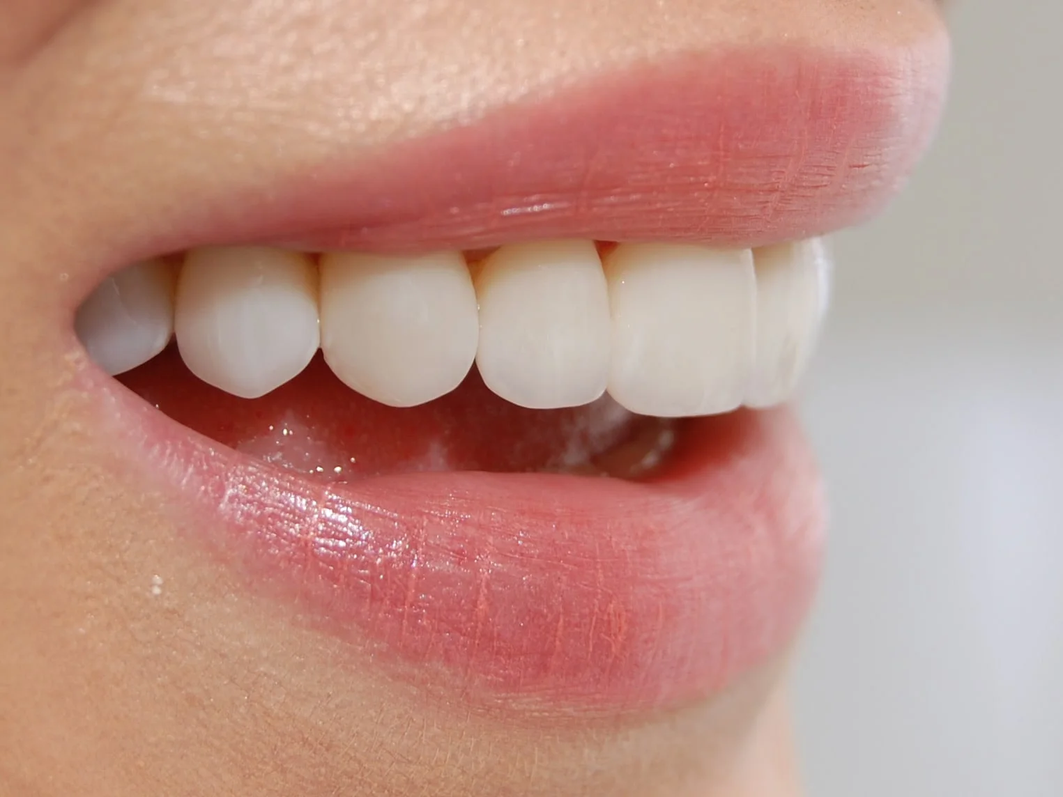 10 porcelain veneers, after treatment, left side view of smile
