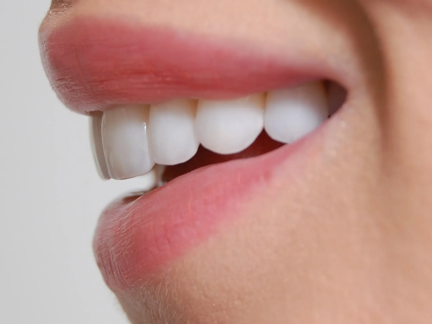 10 porcelain veneers, after treatment, right side view of smile