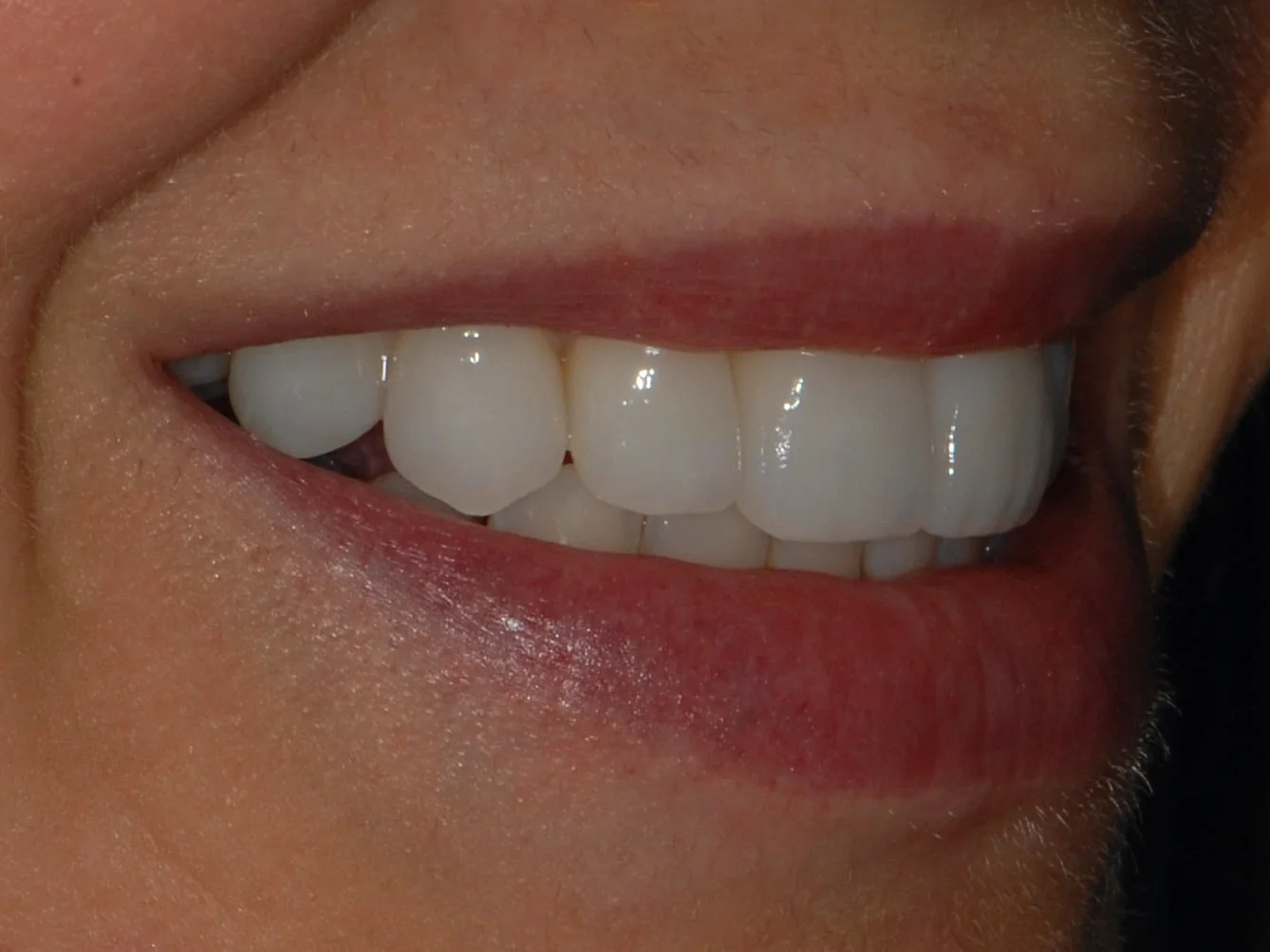 10 porcelain veneers, after treatment, left side view of smile
