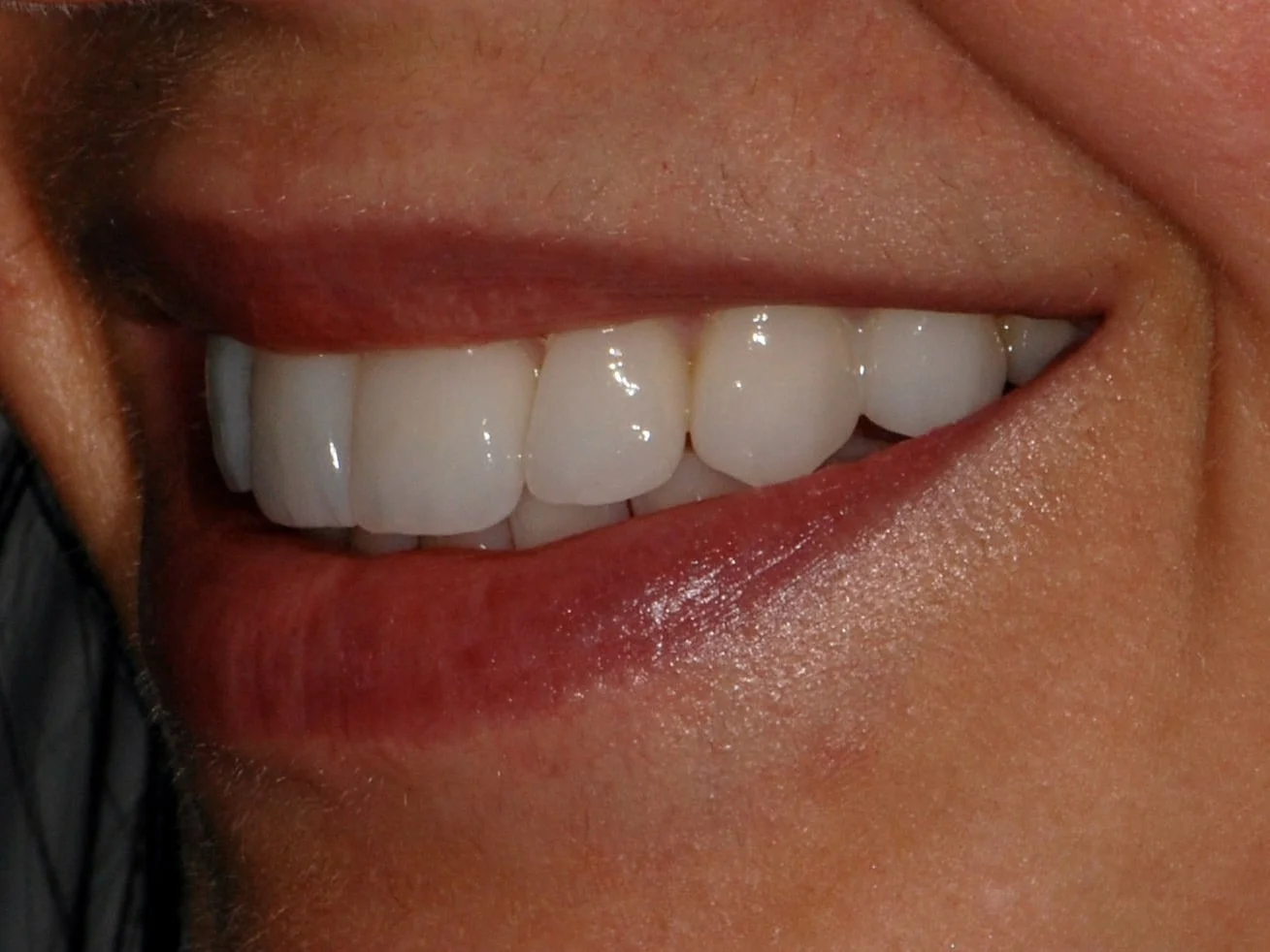 10 porcelain veneers, after treatment, right side view of smile
