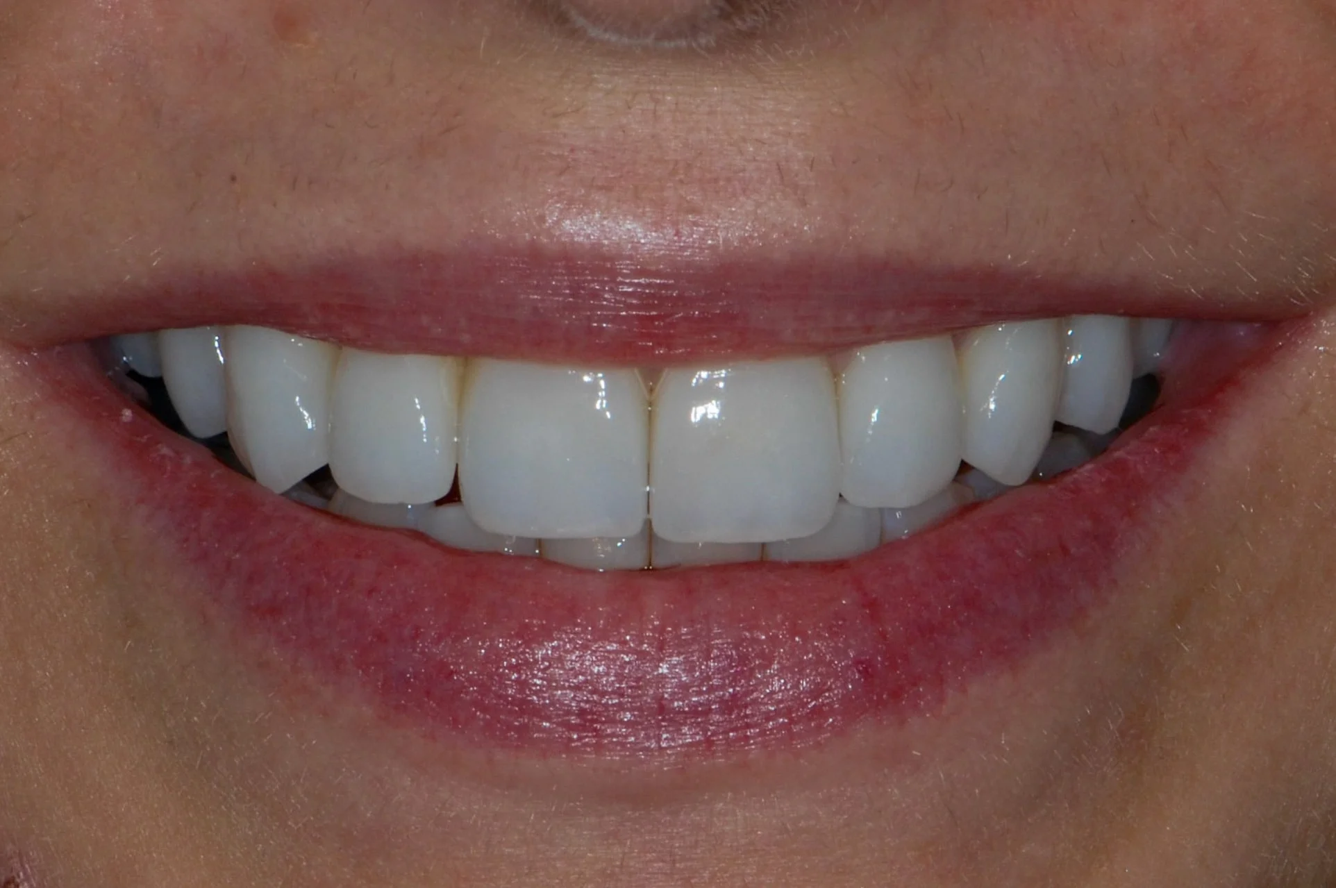10 porcelain veneers, after treatment, front view of smile