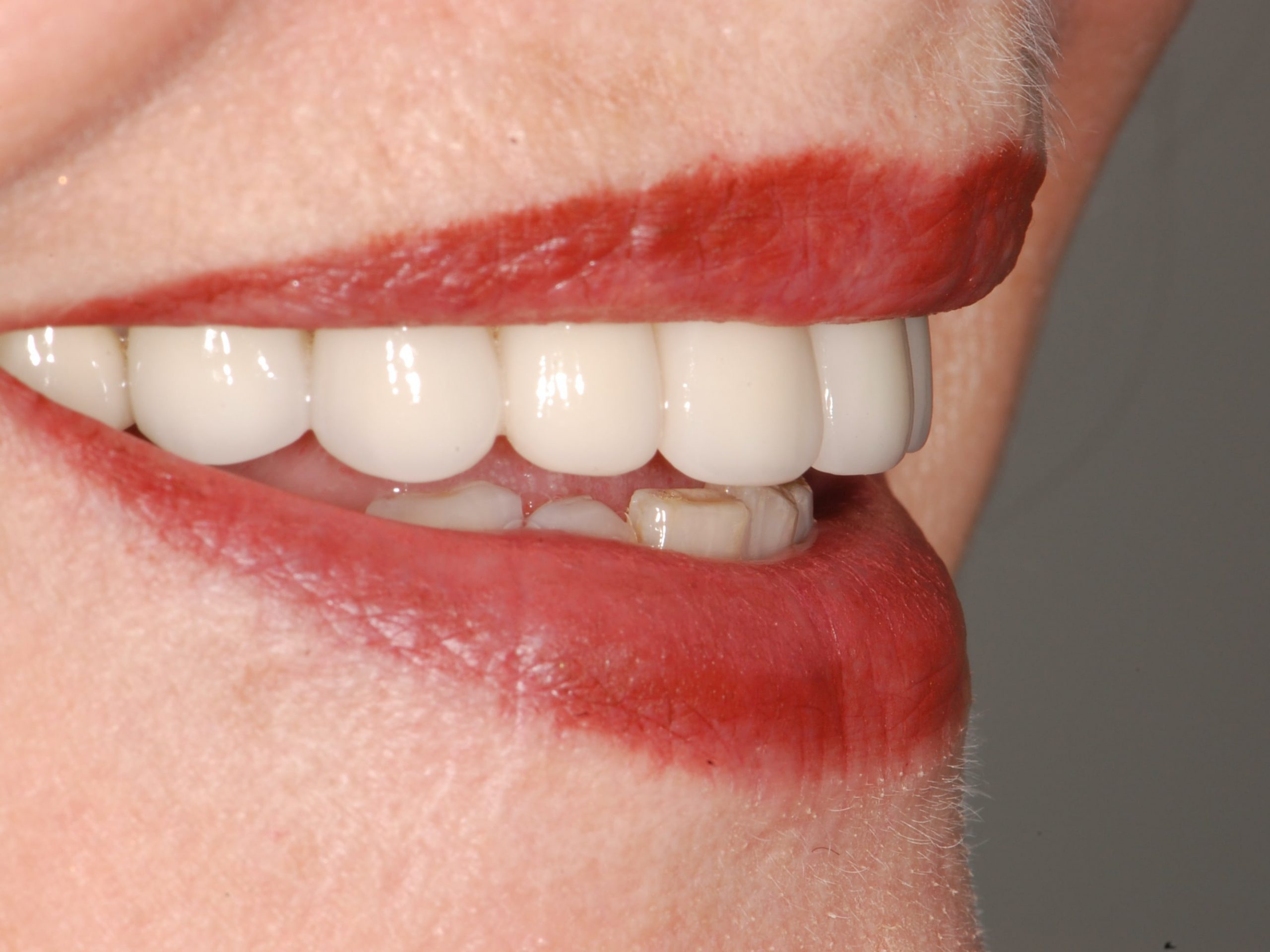 10 porcelain veneers, after treatment, left side view of smile