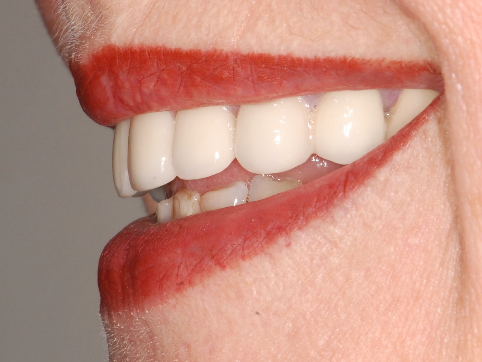 10 porcelain veneers, after treatment, right side view of smile