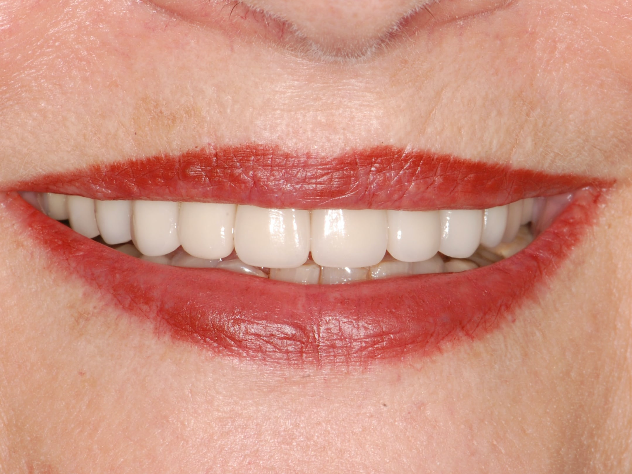 10 porcelain veneers, after treatment, front view of smile