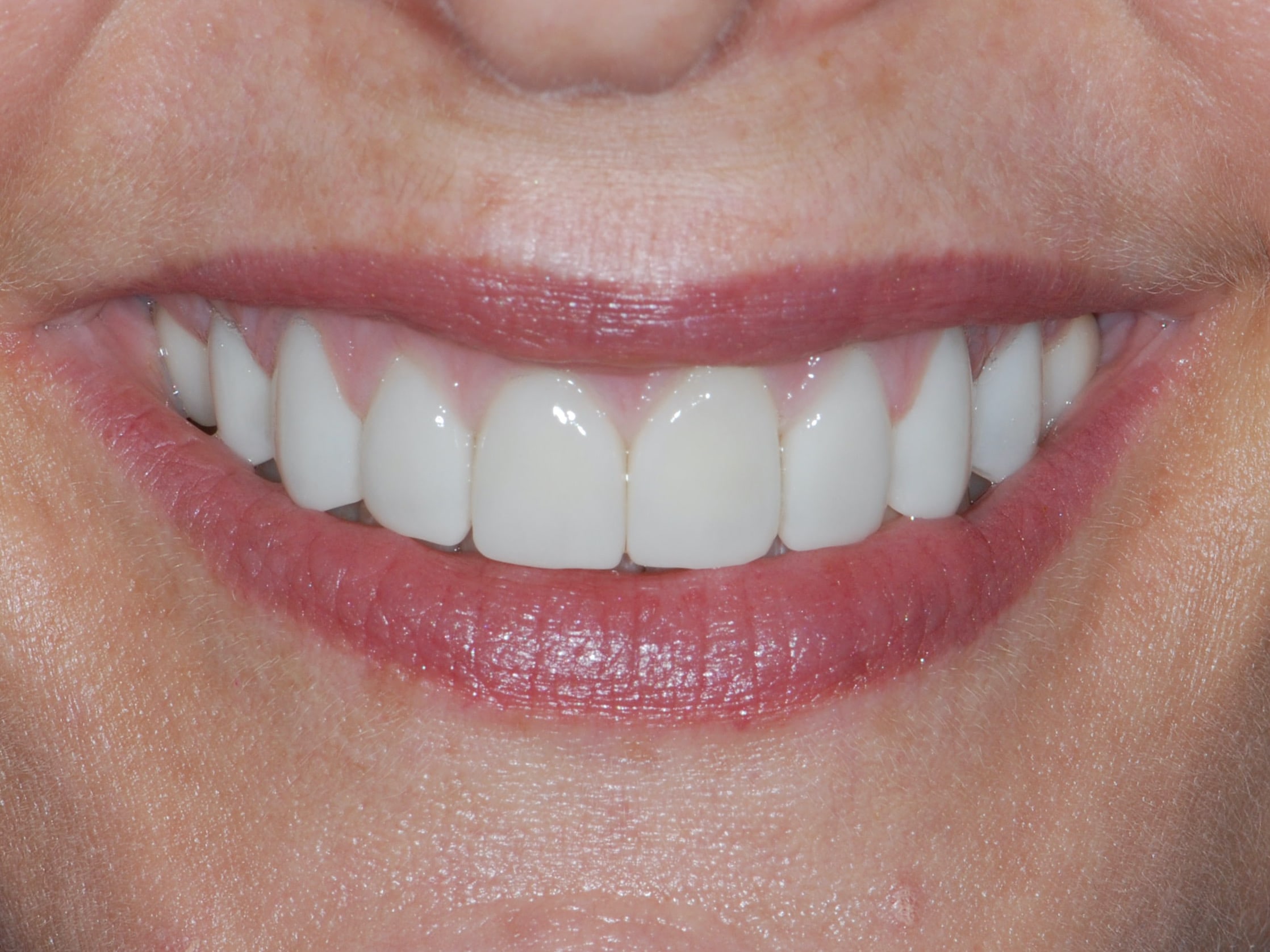 20 porcelain veneers on upper and lower teeth, after treatment, front view of smile