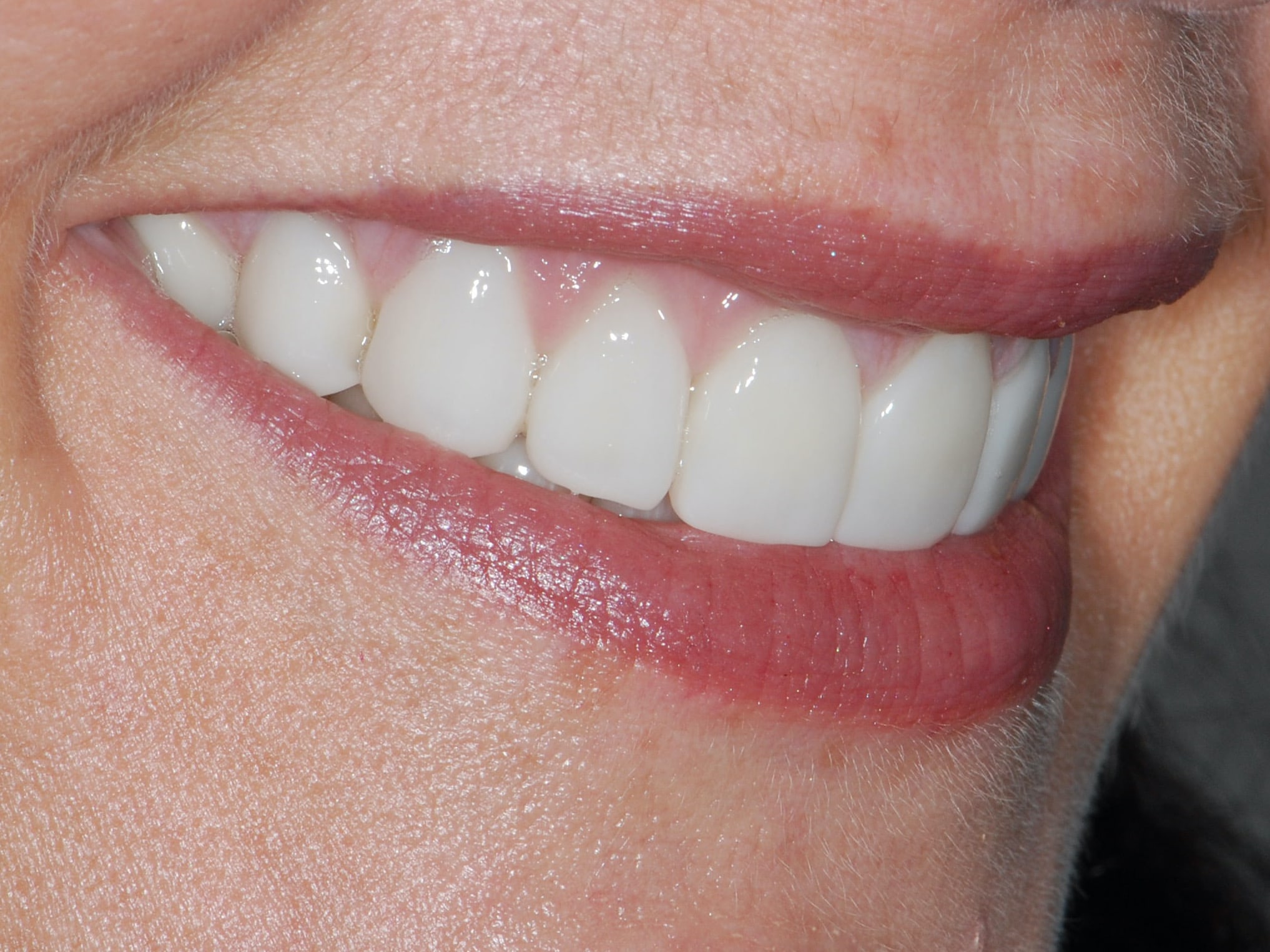 20 porcelain veneers on upper and lower teeth, after treatment, left side view of smile
