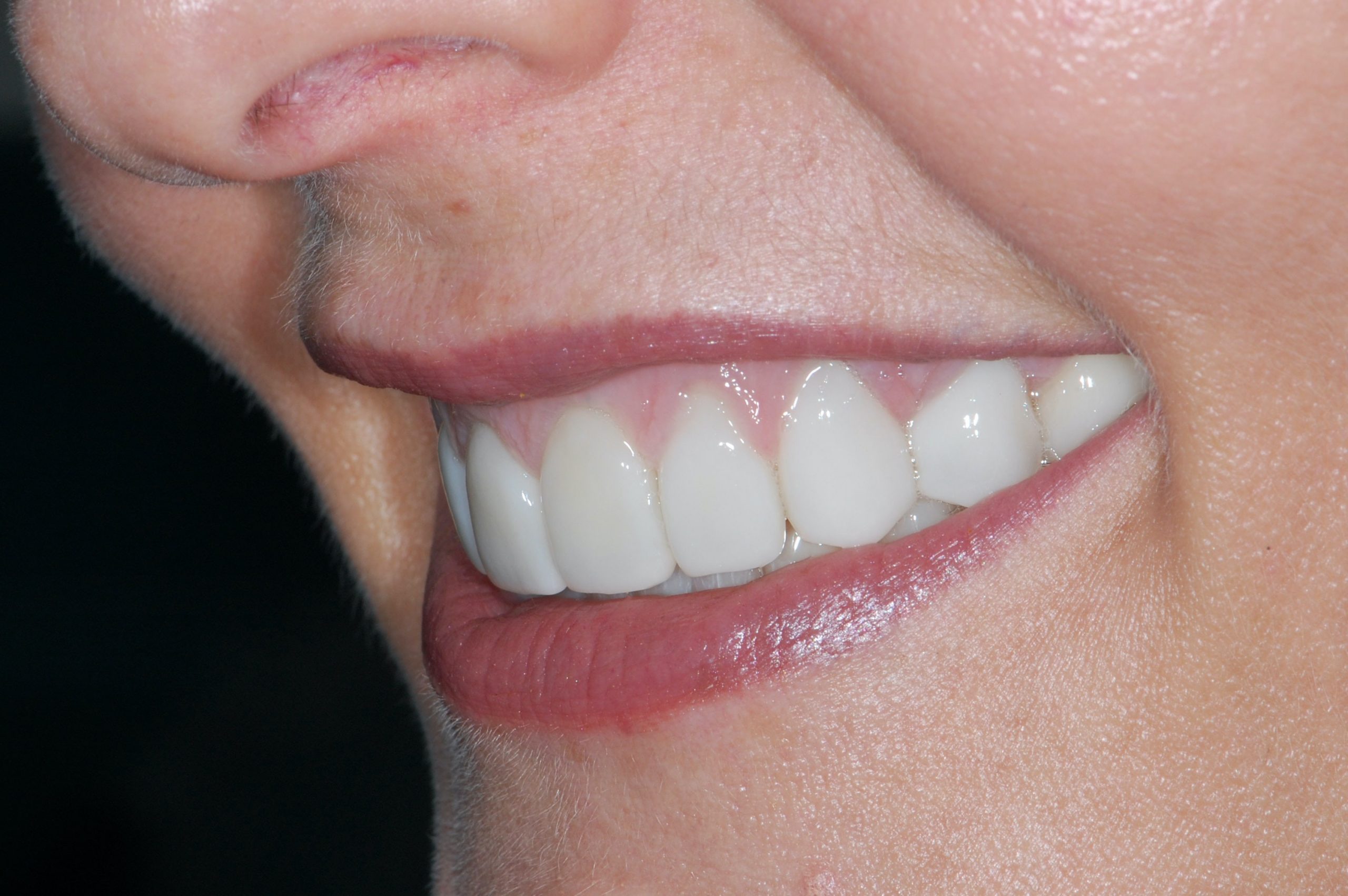 20 porcelain veneers on upper and lower teeth, after treatment, right side view of smile