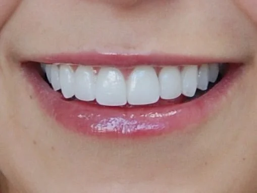 Porcelain veneers, after treatment, front view of smile