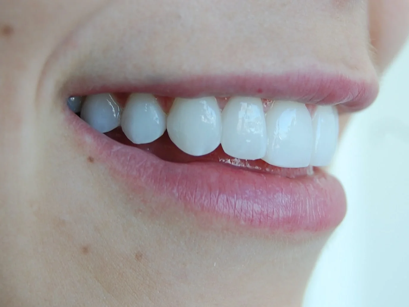 Porcelain veneers, after treatment, left side view of smile