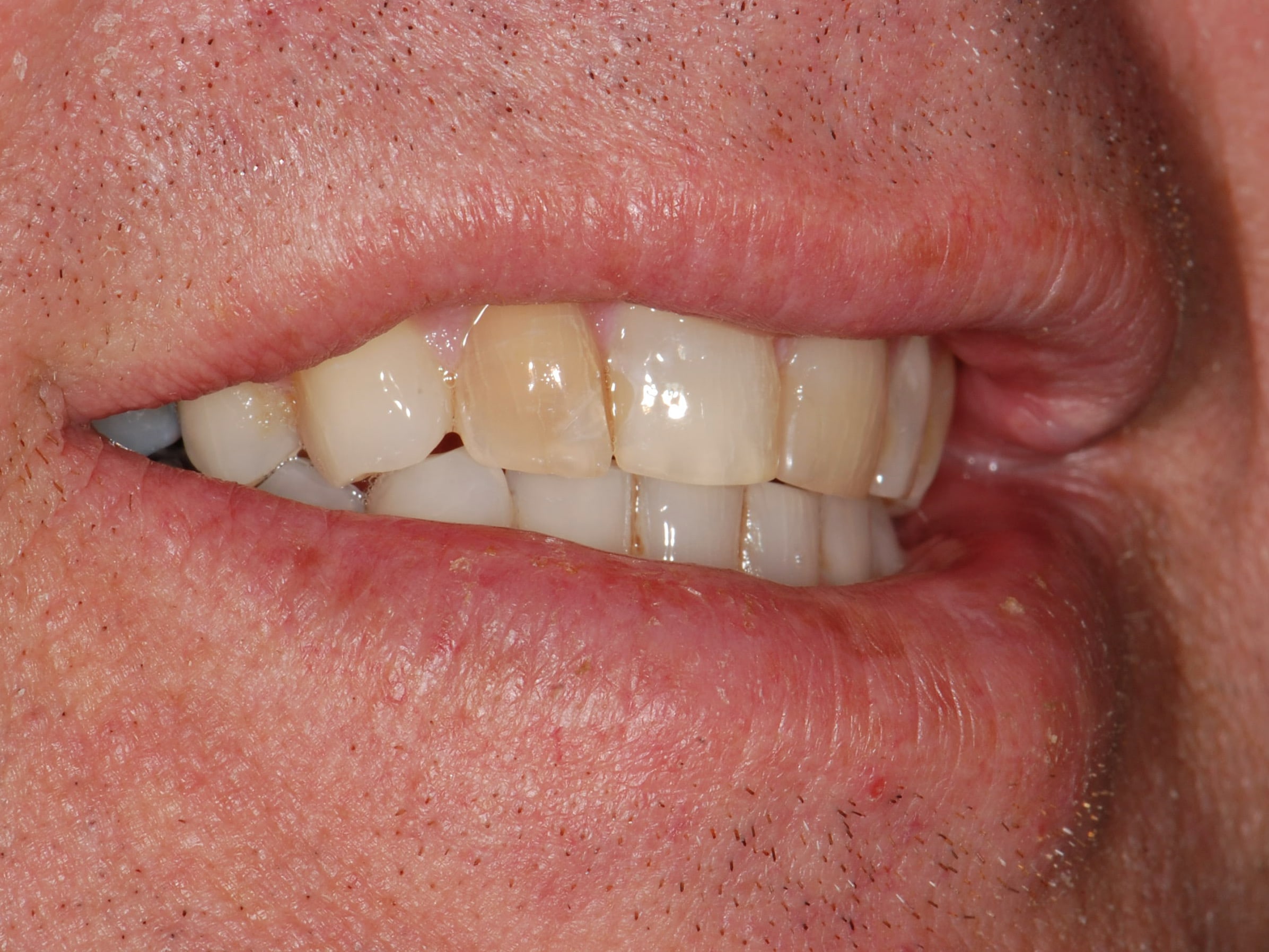 8 porcelain veneers, before treatment, left side view of smile
