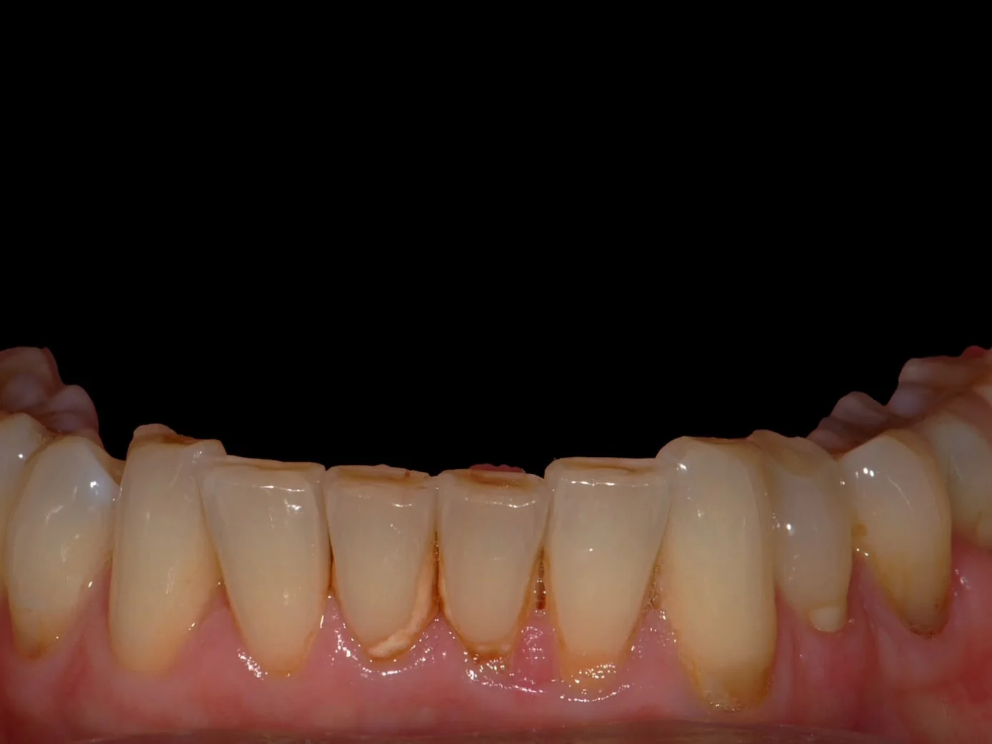 8 porcelain veneers, before treatment, close-up of the lower teeth