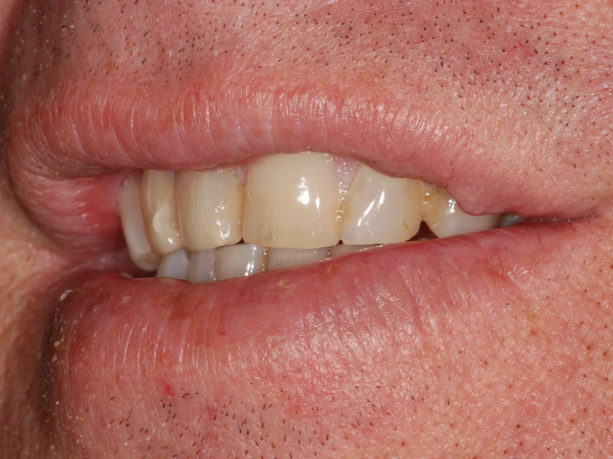 8 porcelain veneers, before treatment, right side view of smile
