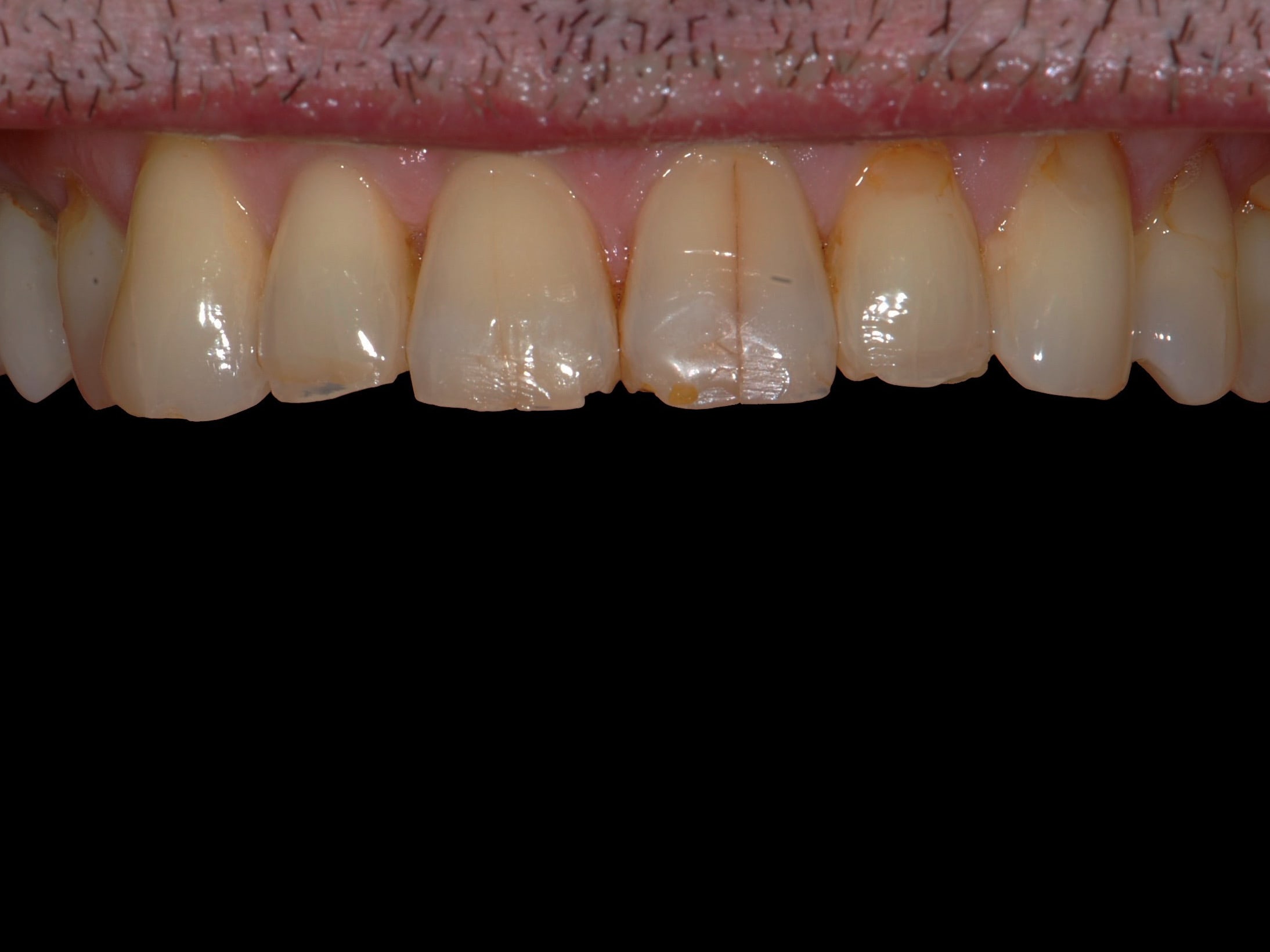 8 porcelain veneers, before treatment, close-up of the upper teeth