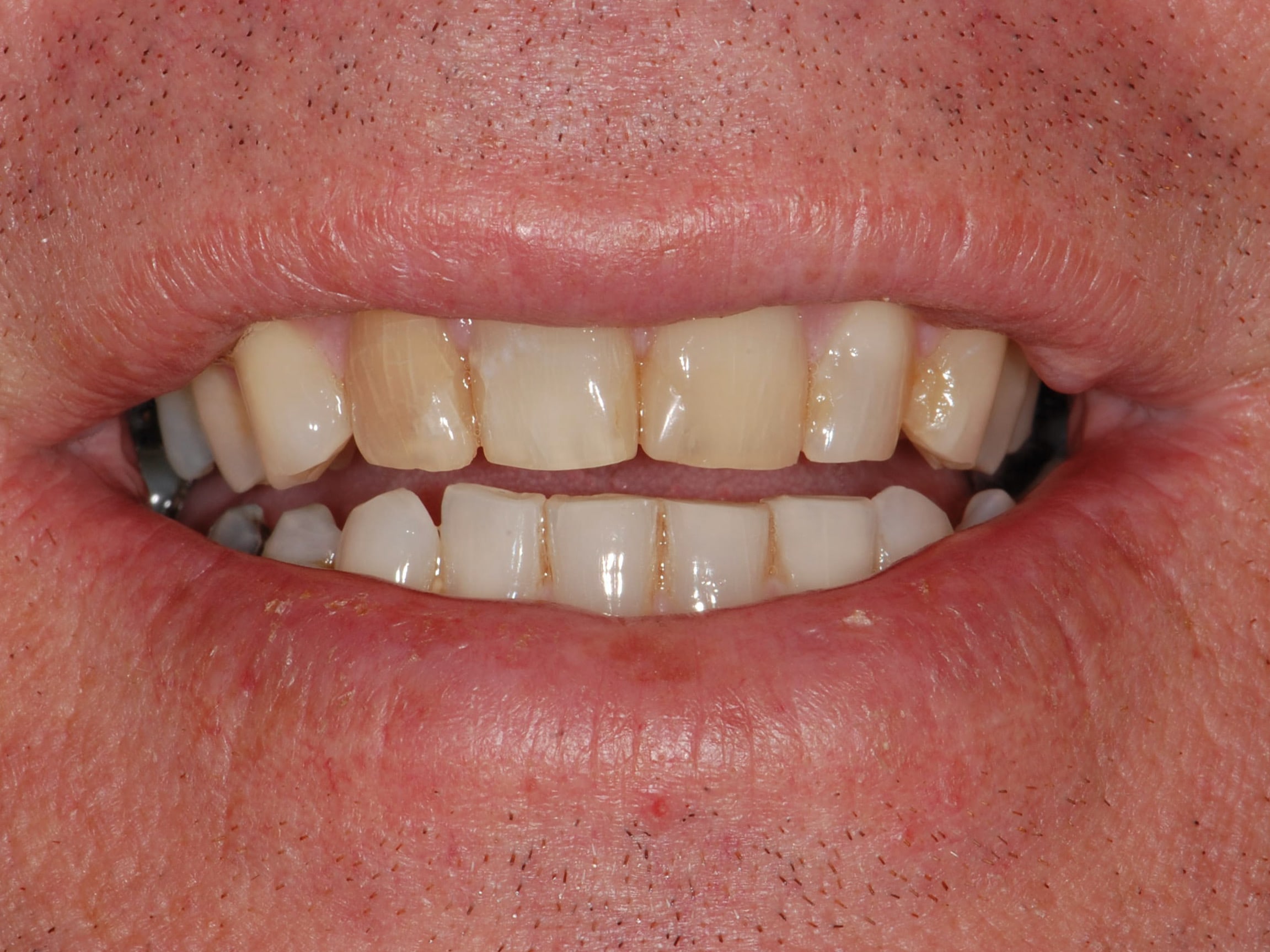 8 porcelain veneers, before treatment, front view of smile