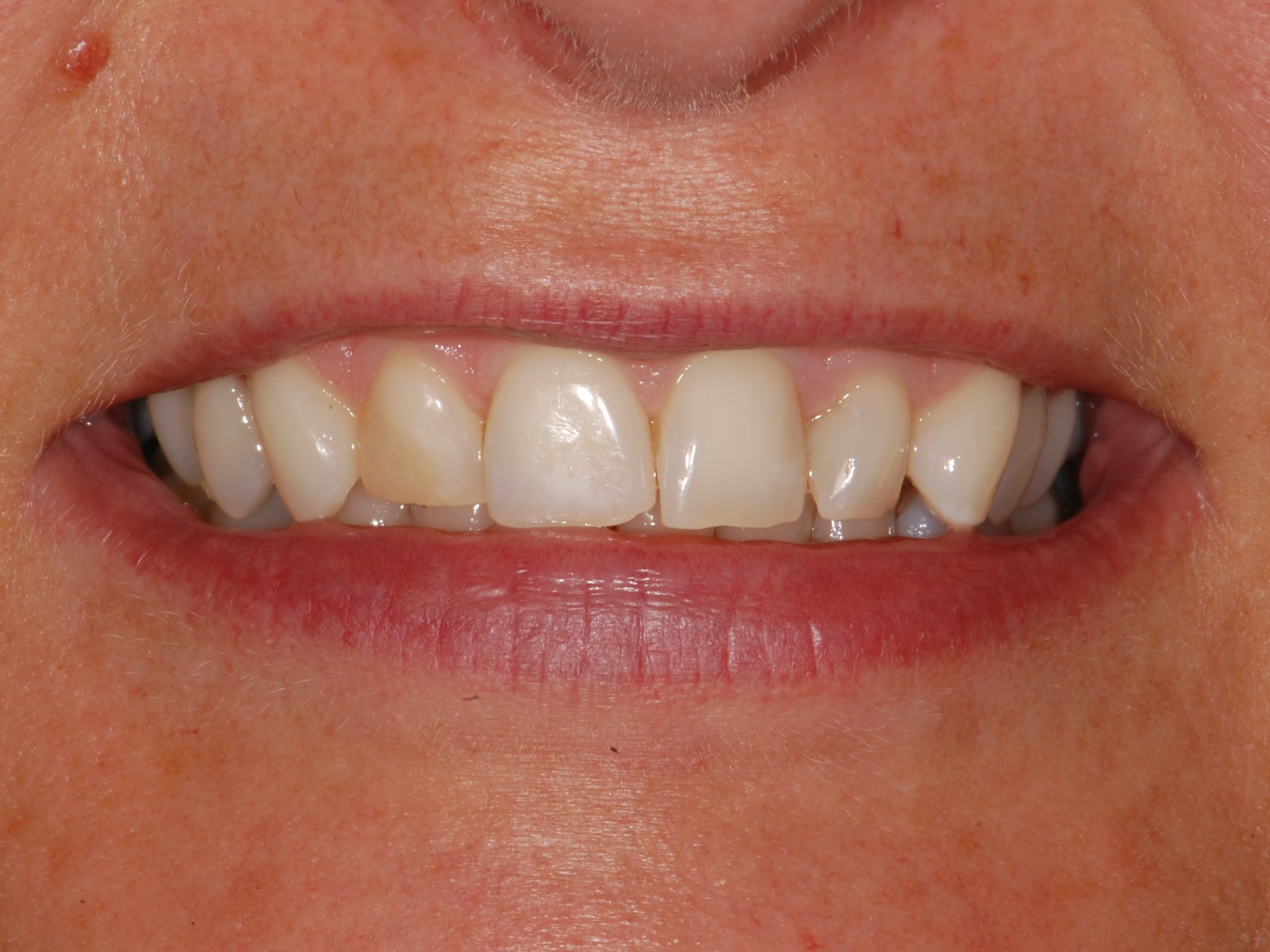 8 porcelain veneers, before treatment, front view of smile
