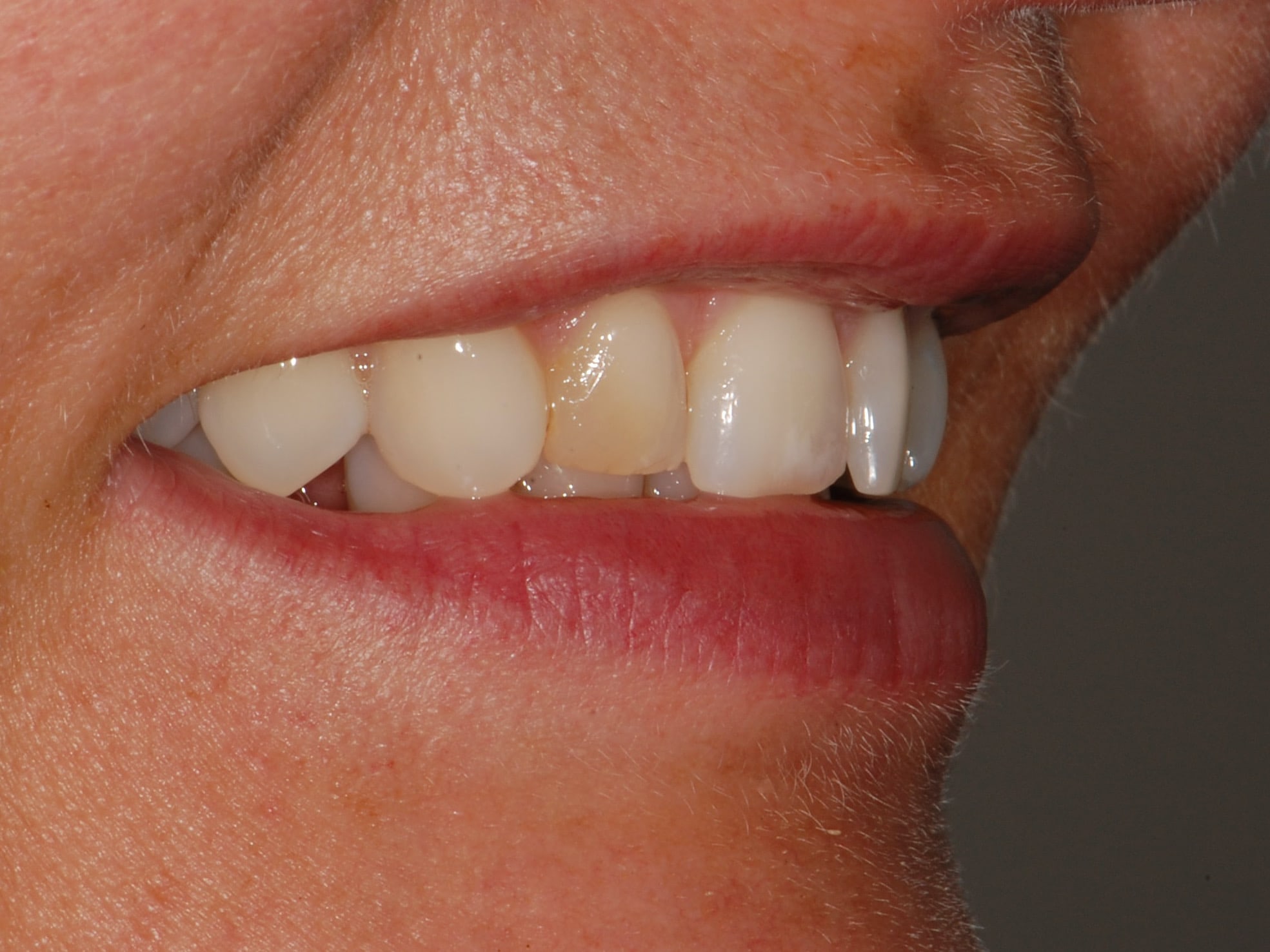 8 porcelain veneers, before treatment, left side view of smile