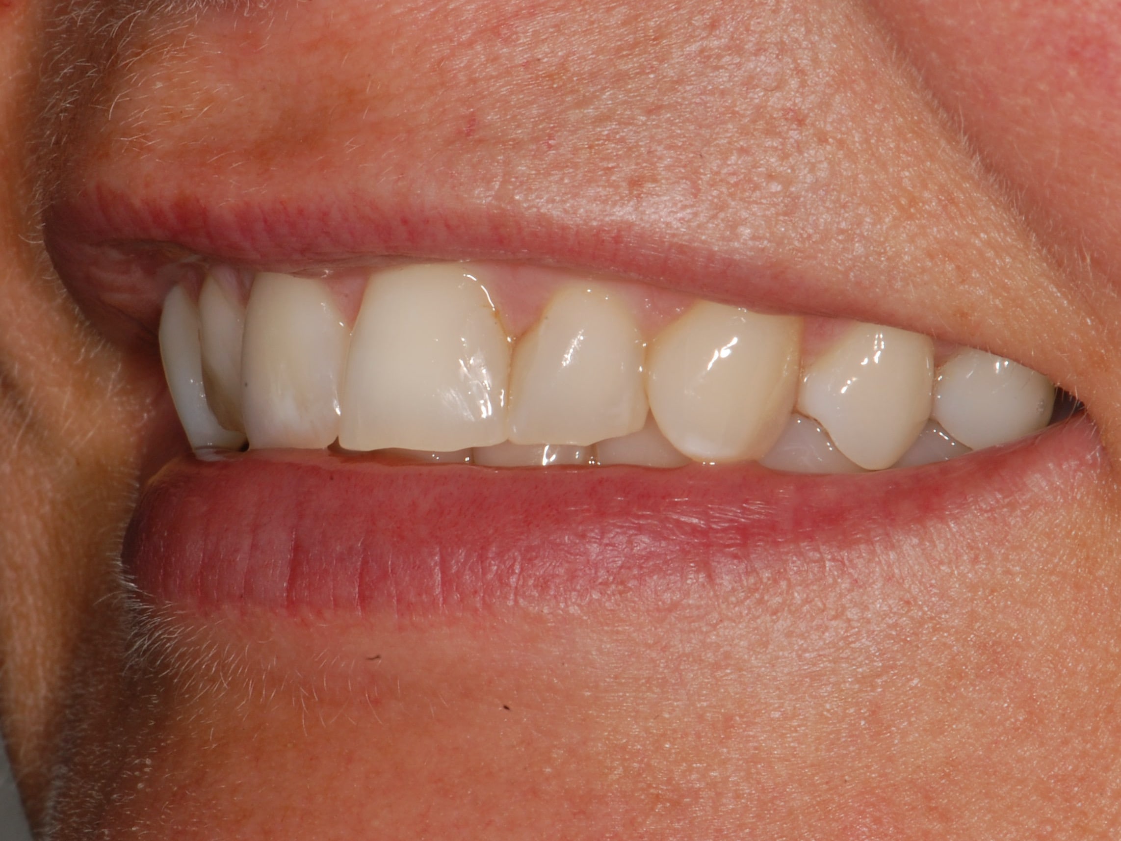 8 porcelain veneers, before treatment, right side view of smile