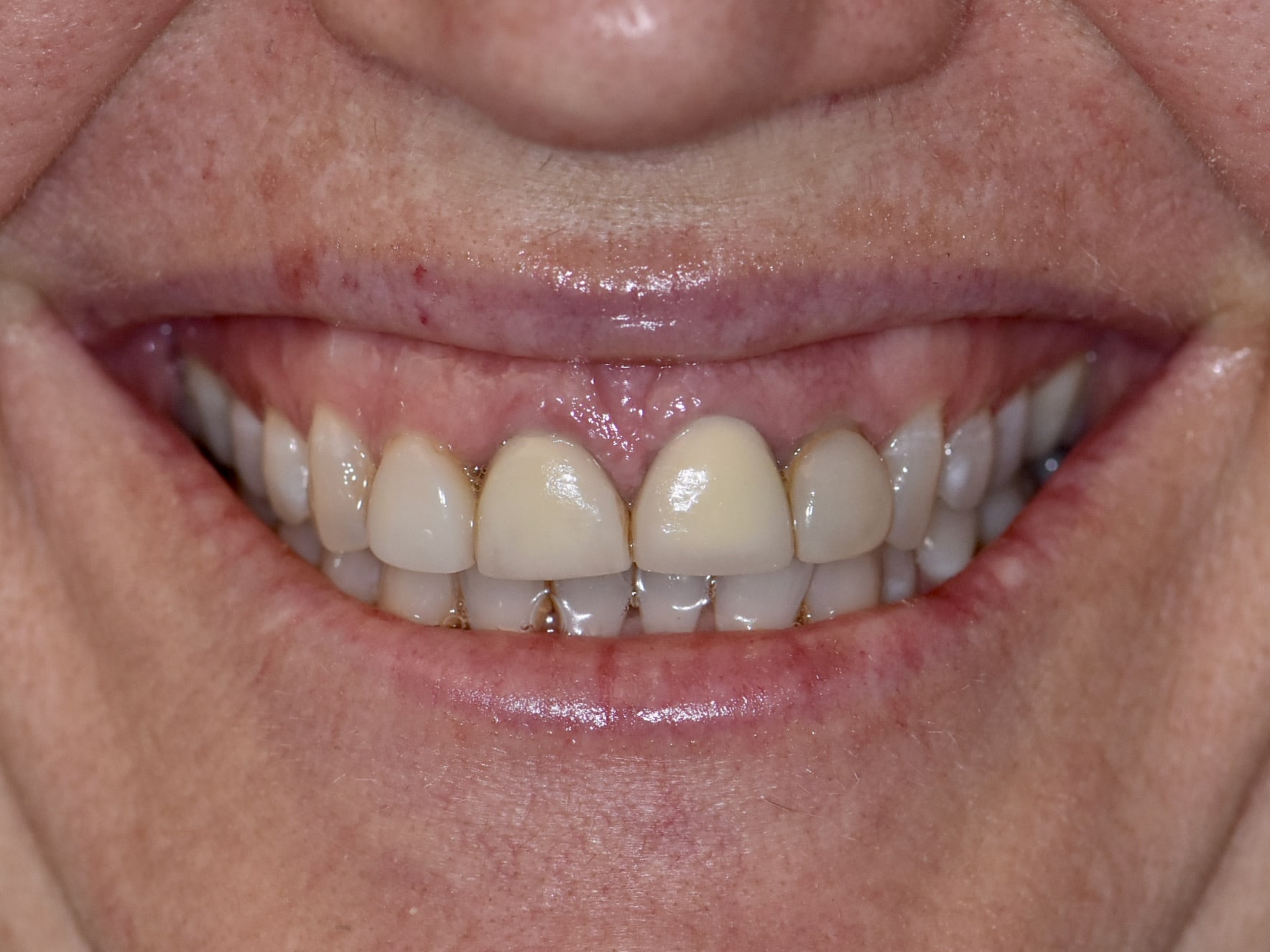 Gum lift, dental crowns and porcelain veneers, before treatment, front view of smile