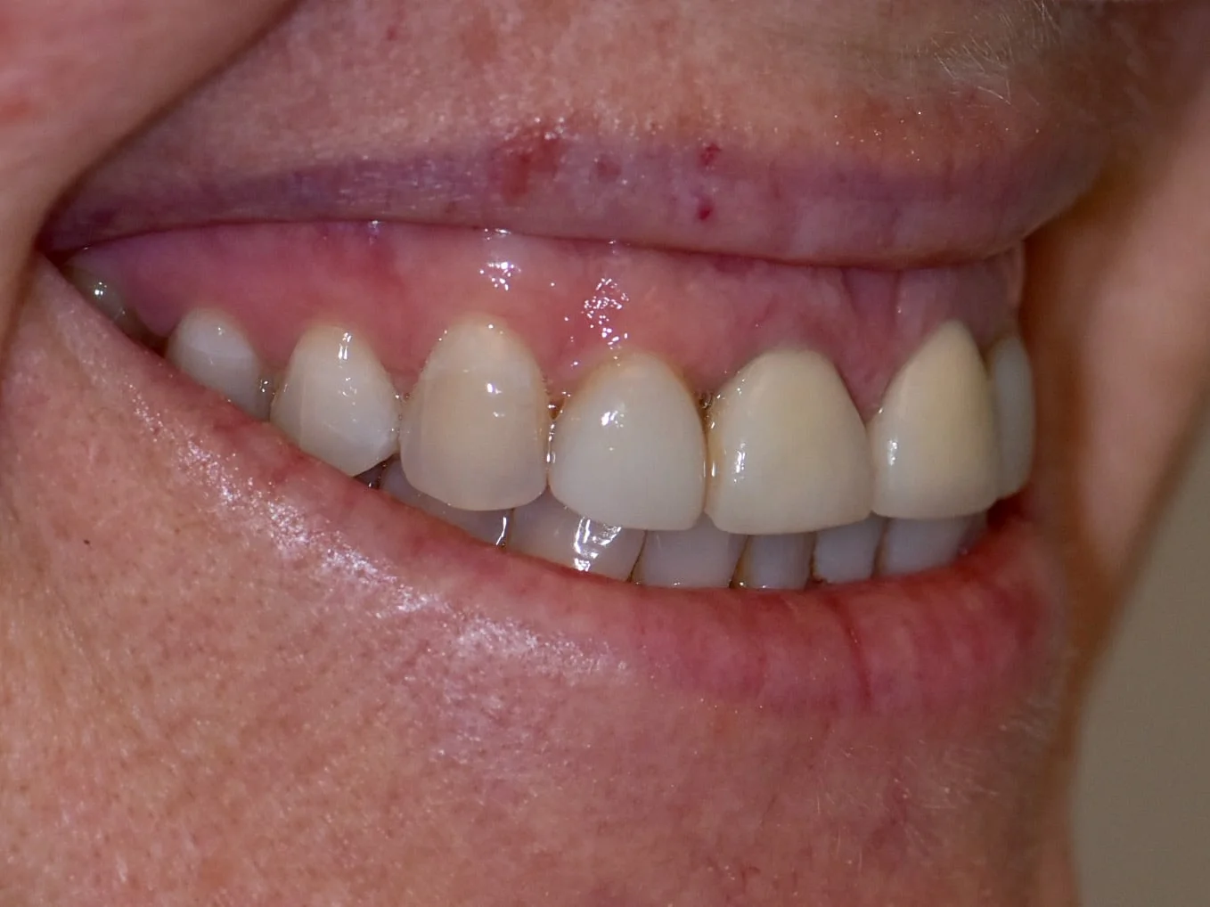 Gum lift, dental crowns and porcelain veneers, before treatment, left side view of smile