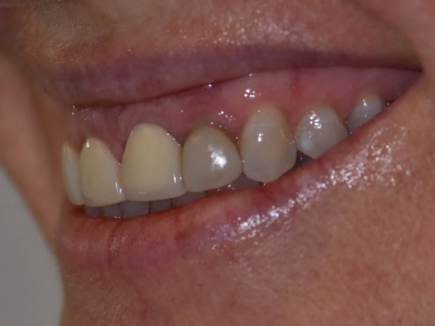 Gum lift, dental crowns and porcelain veneers, before treatment, right side view of smile