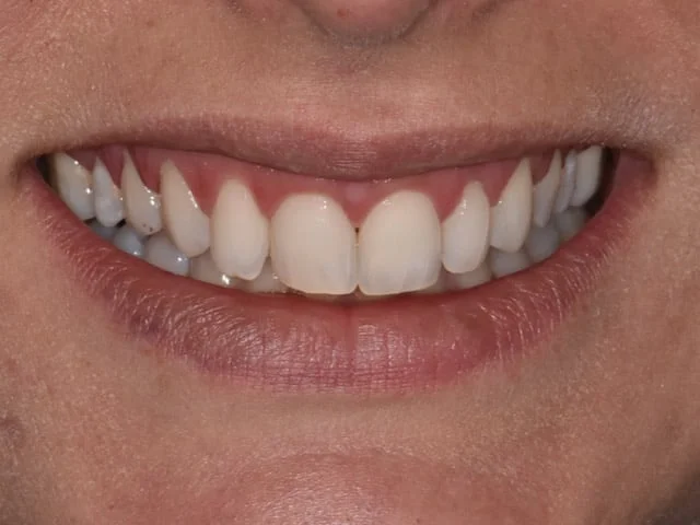 10 porcelain veneers, before treatment, front view of smile