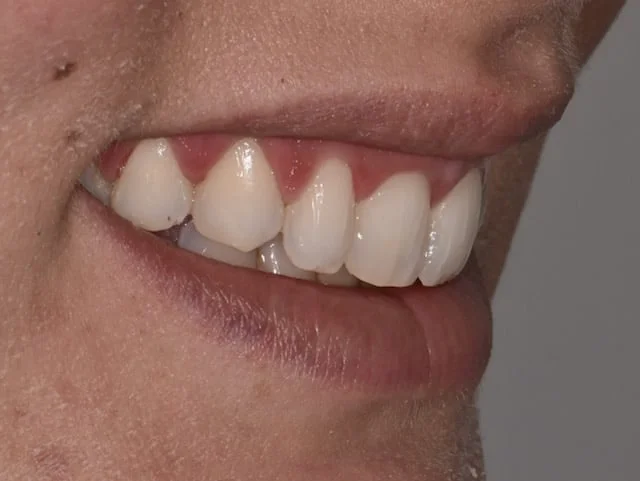 10 porcelain veneers, before treatment, left side view of smile