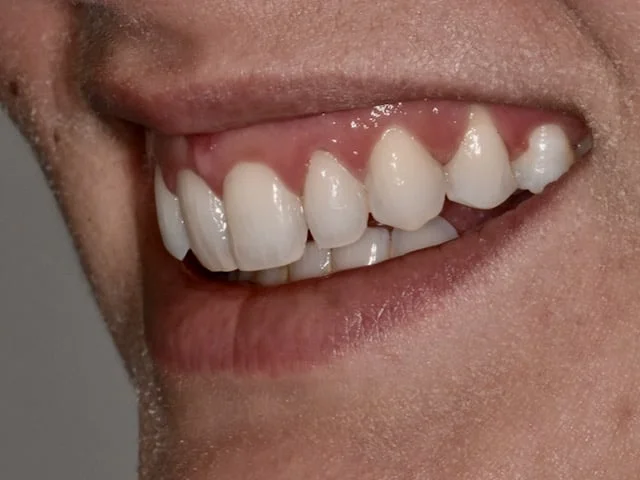 10 porcelain veneers, before treatment, right side view of smile