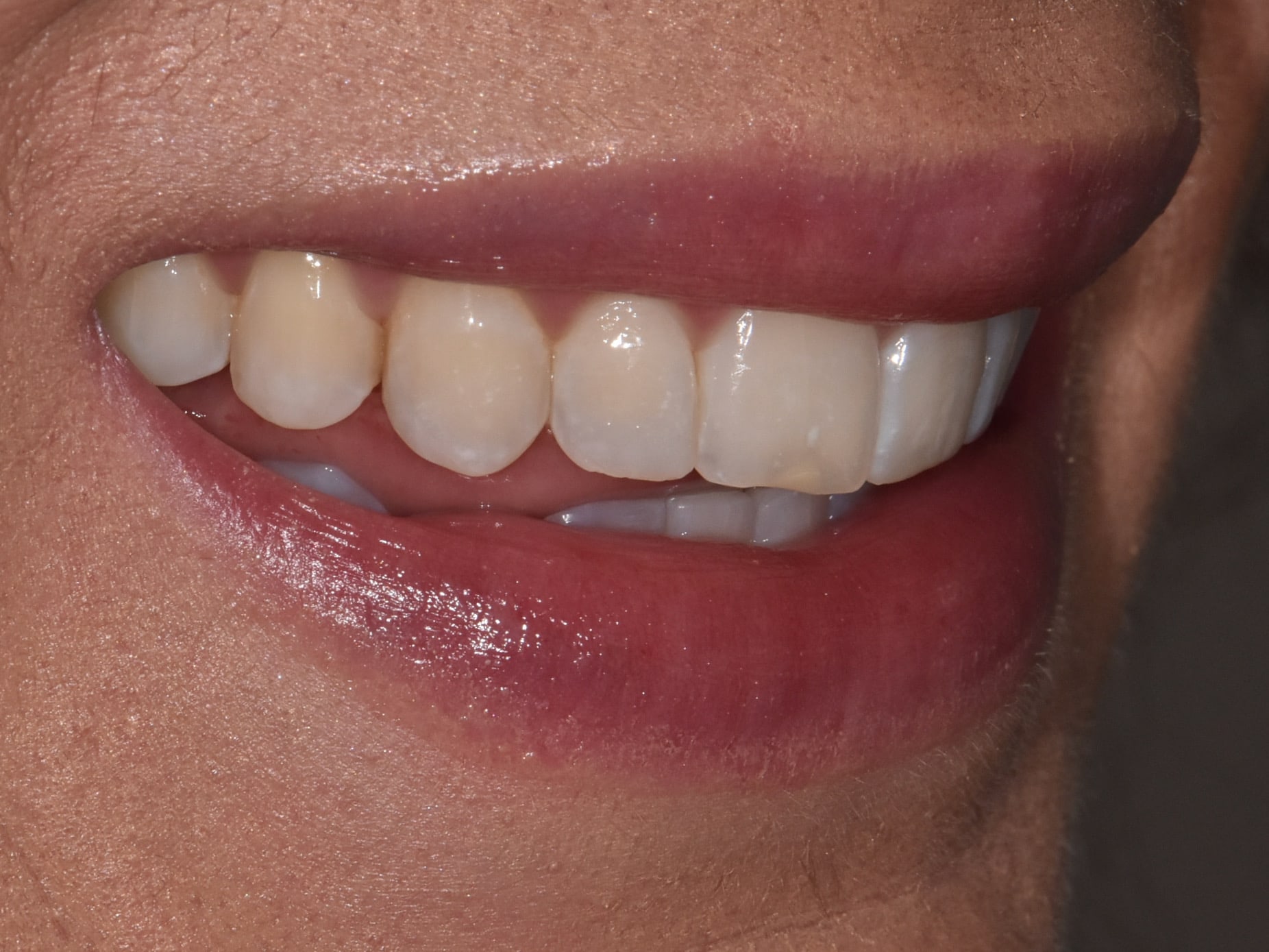 10 porcelain veneers, before treatment, left side view of smile