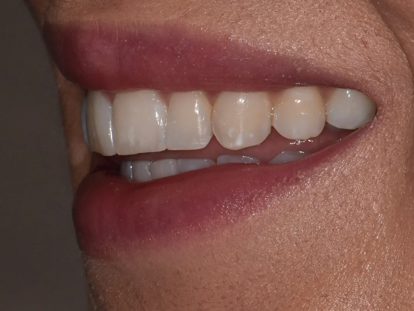 10 porcelain veneers, before treatment, right side view of smile