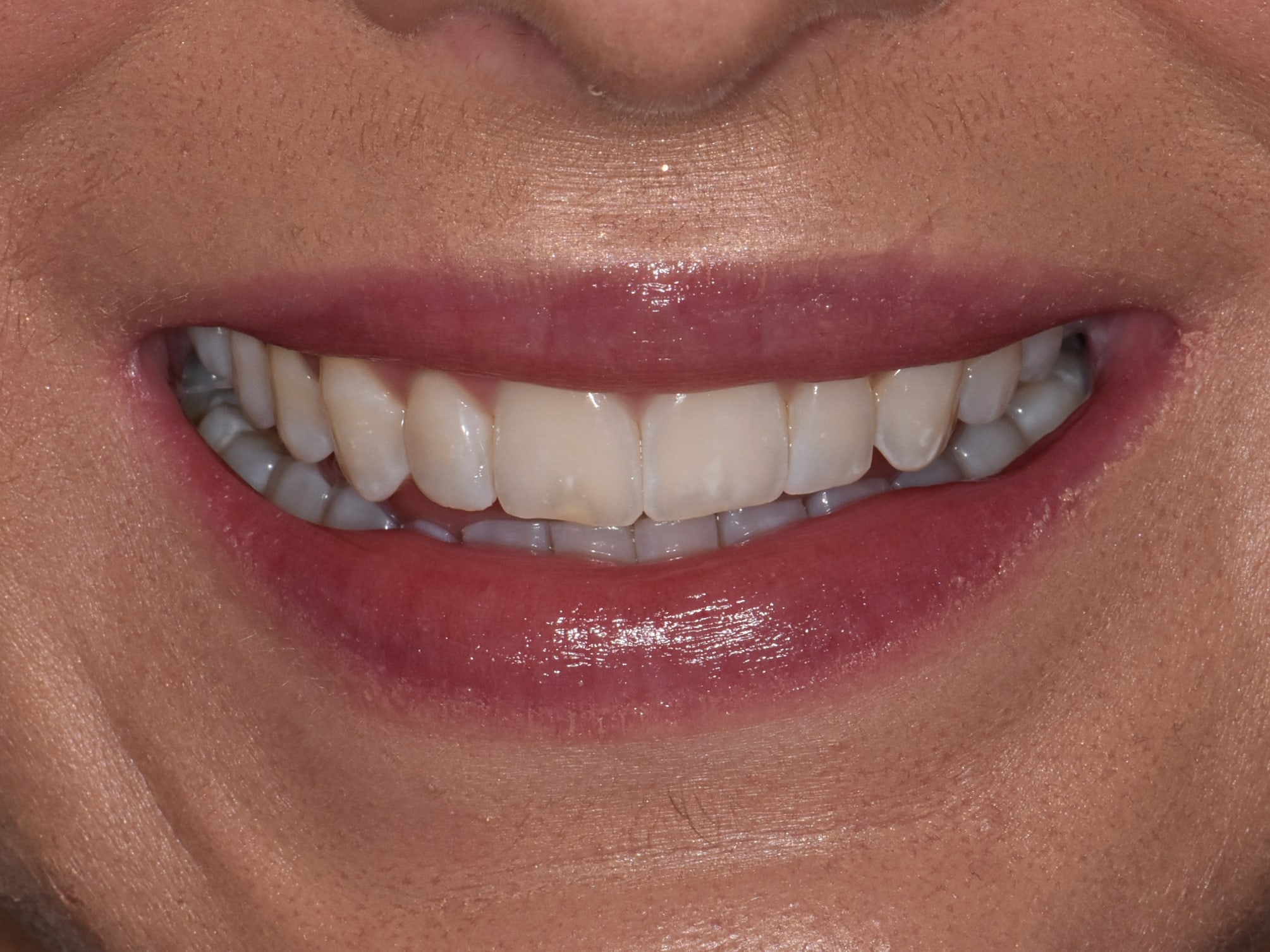 10 porcelain veneers, before treatment, front view of smile