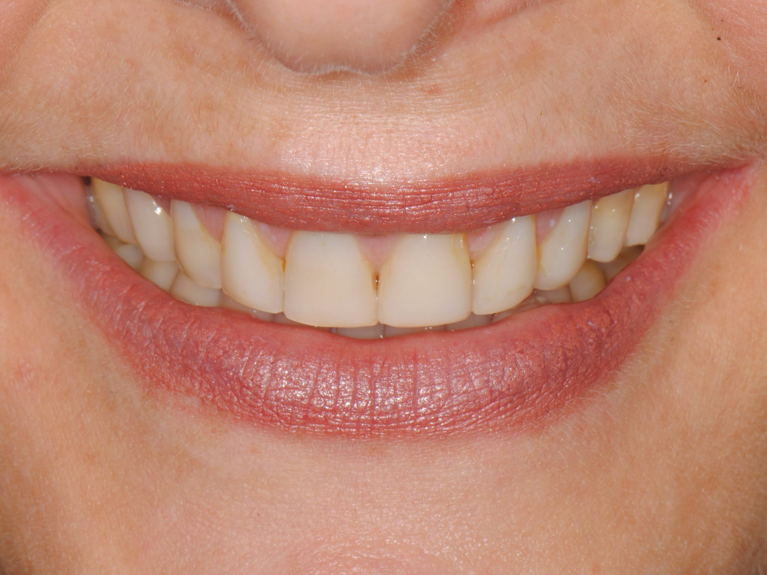 20 porcelain veneers on upper and lower teeth, before treatment, front view of smile